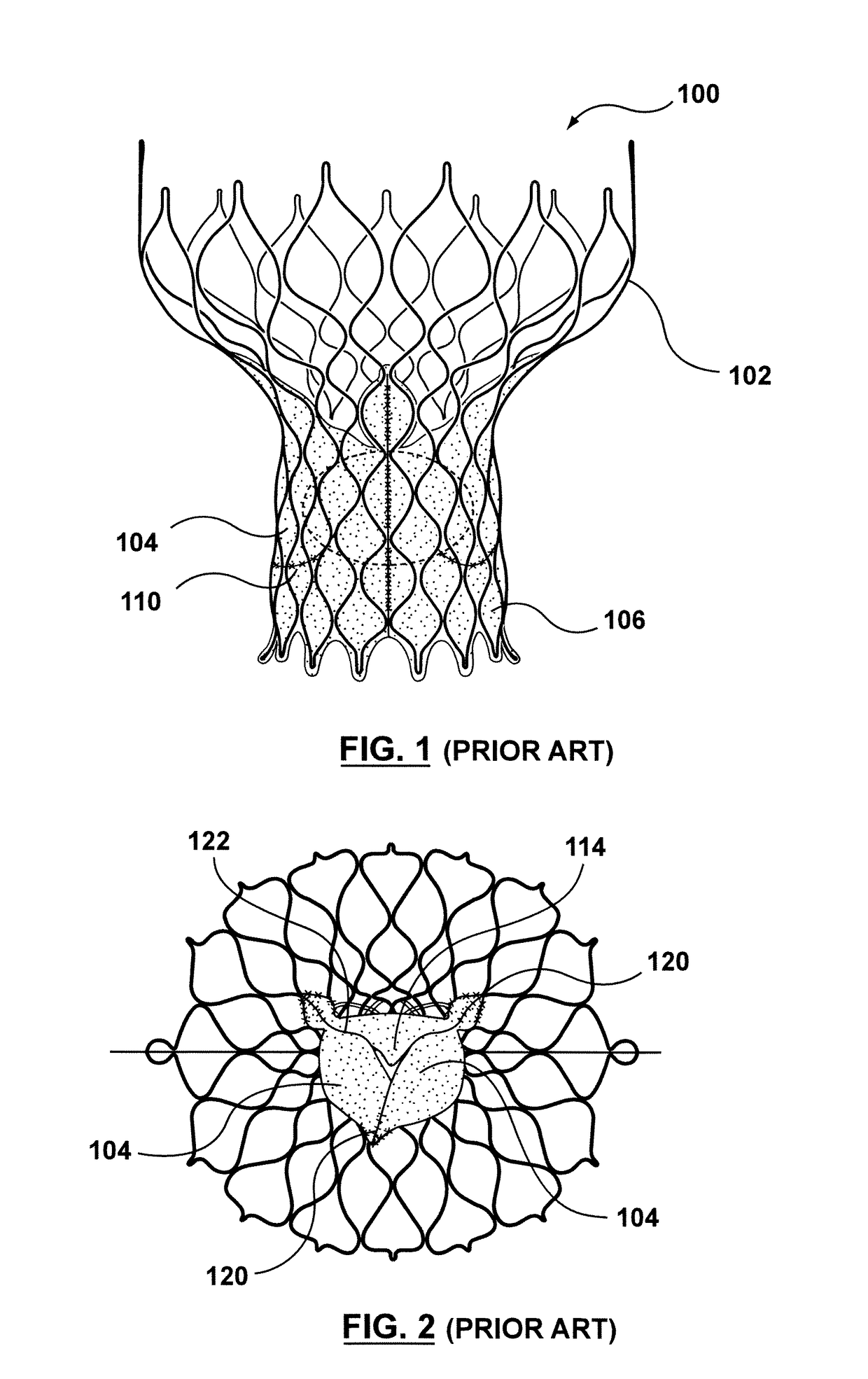 Transcatheter valve prosthesis having an external skirt for sealing and preventing paravalvular leakage