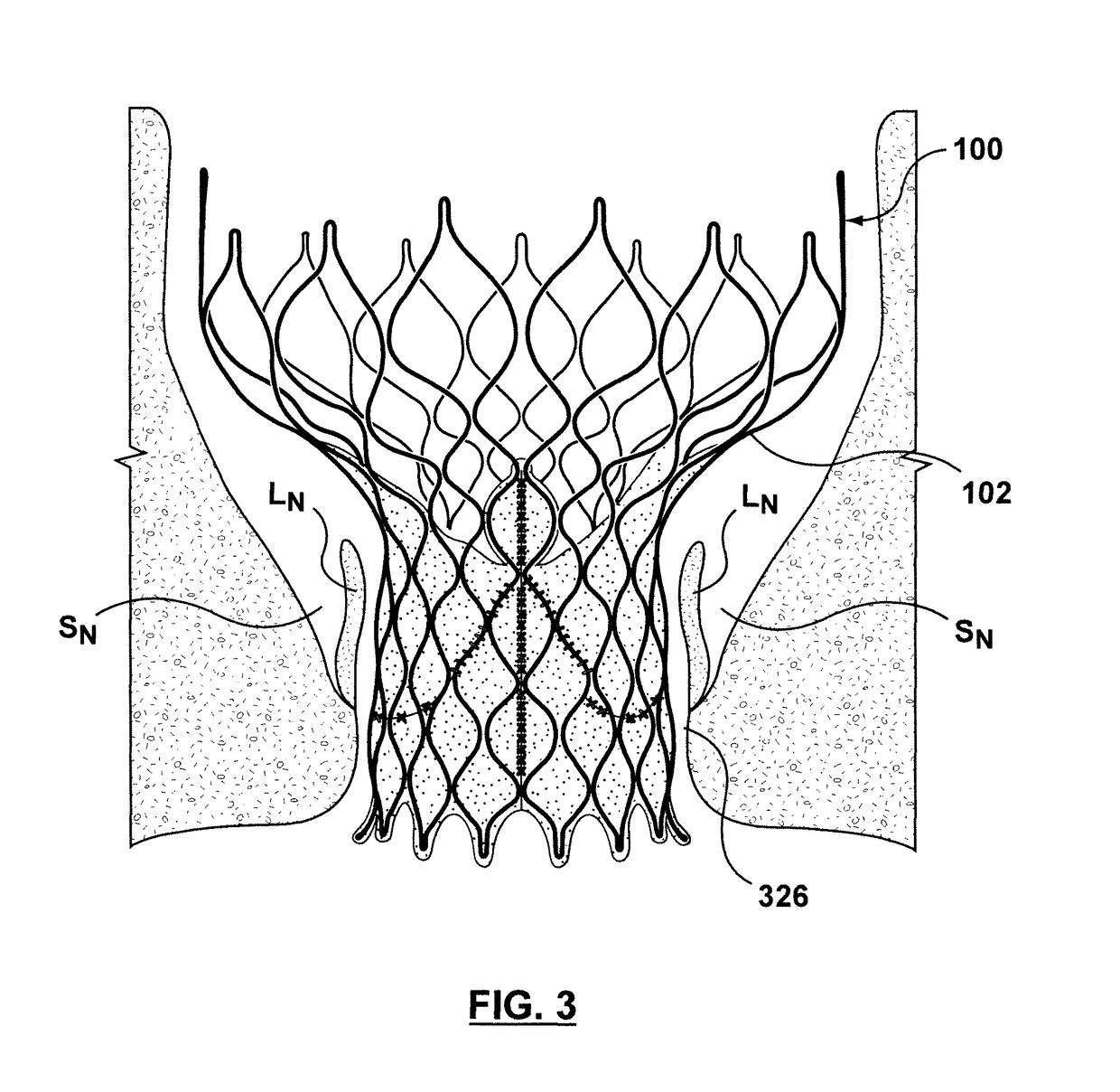 Transcatheter valve prosthesis having an external skirt for sealing and preventing paravalvular leakage