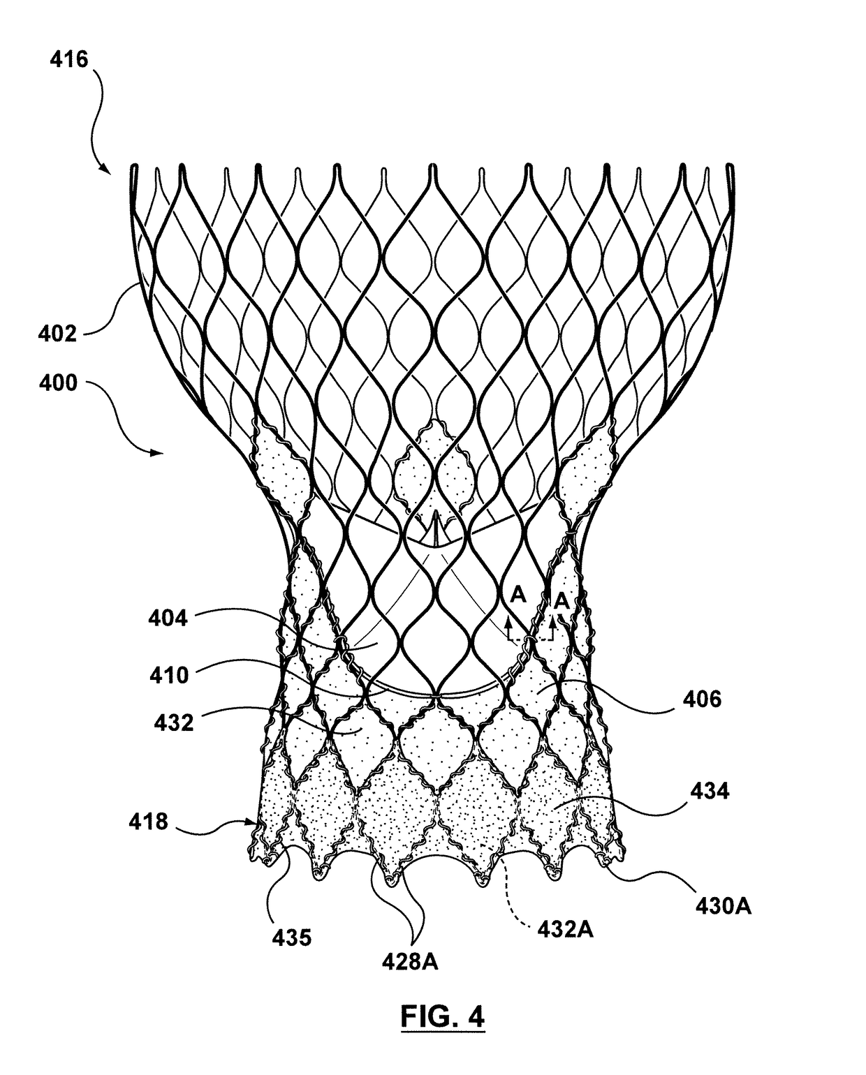 Transcatheter valve prosthesis having an external skirt for sealing and preventing paravalvular leakage