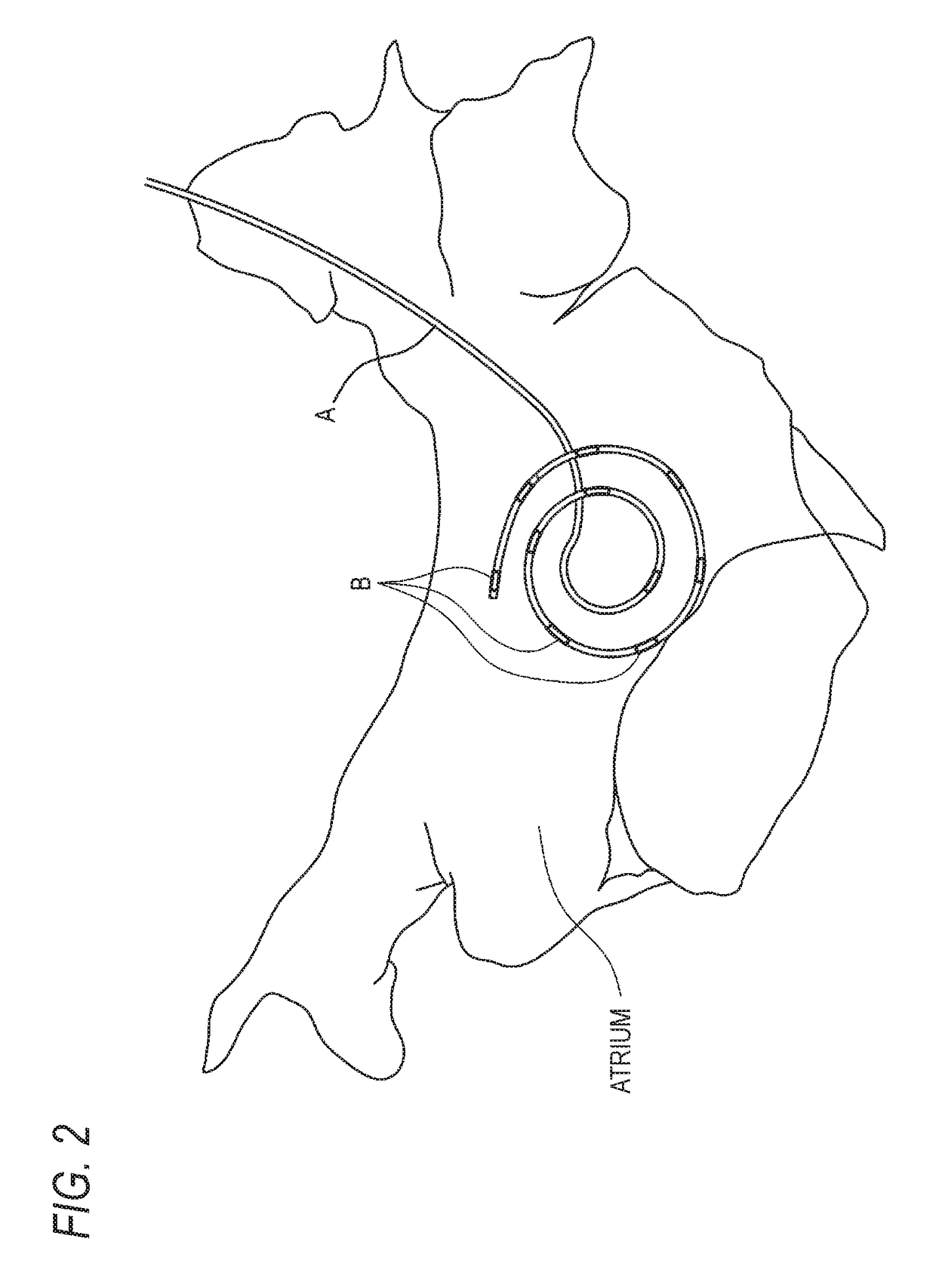 Myocardial excitation complementation/visualization apparatus and myocardial excitation detection apparatus