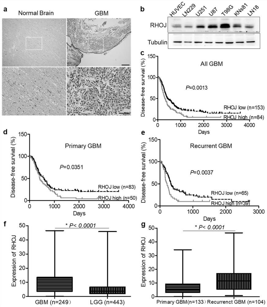 Application of malignant glioma biomarker