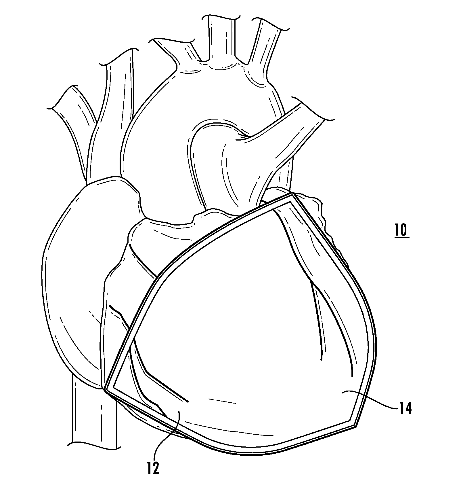 Bioactive implant for myocardial regeneration and ventricular chamber restoration