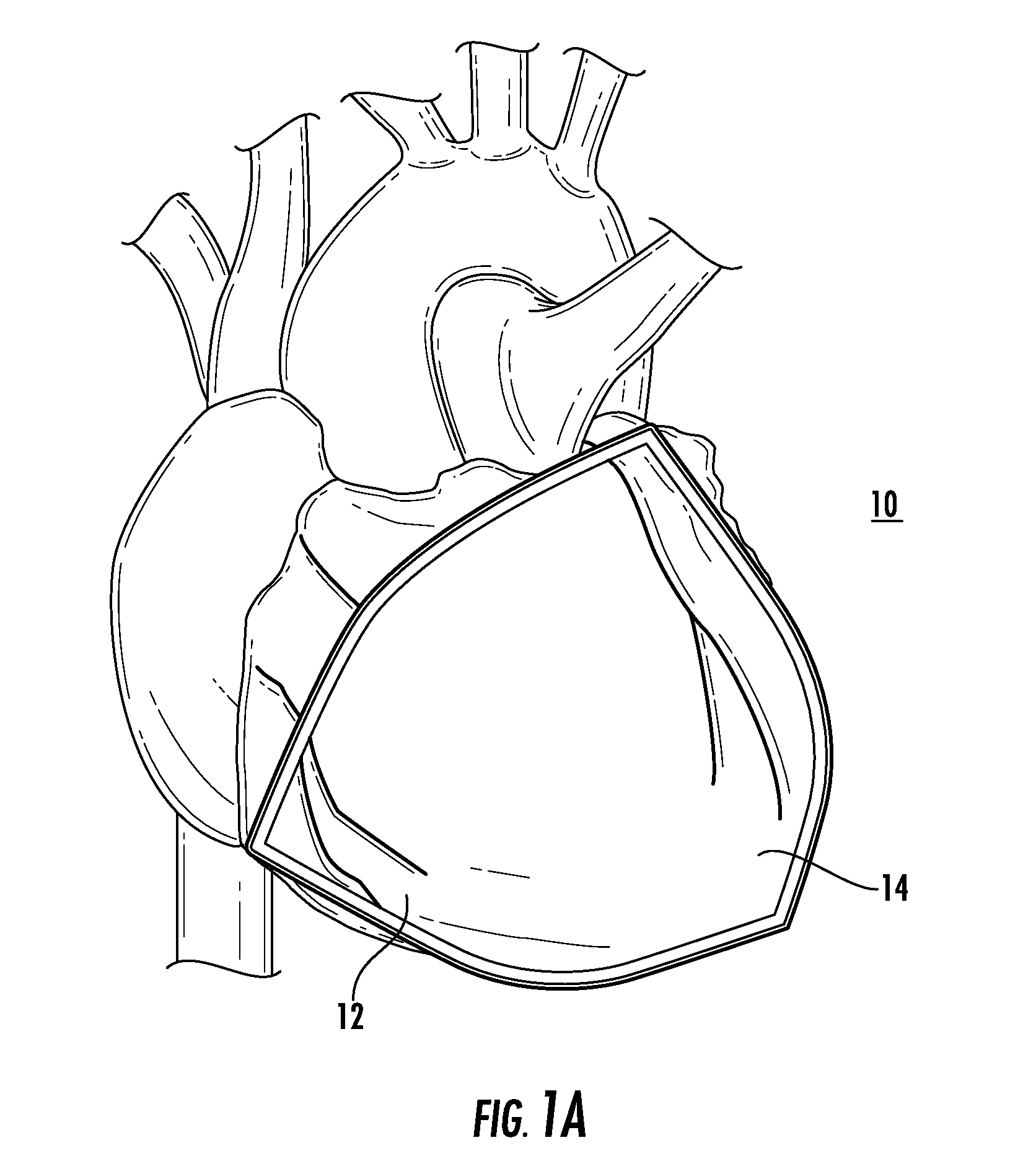 Bioactive implant for myocardial regeneration and ventricular chamber restoration