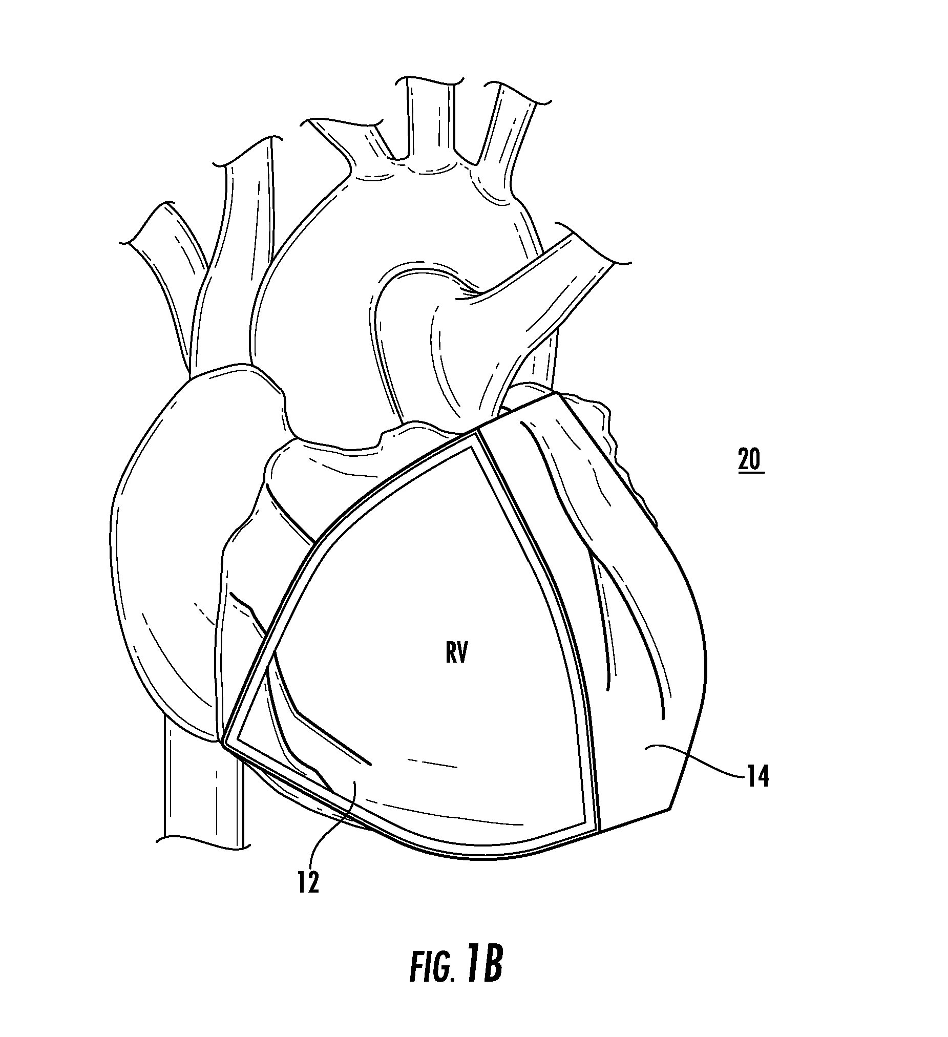 Bioactive implant for myocardial regeneration and ventricular chamber restoration