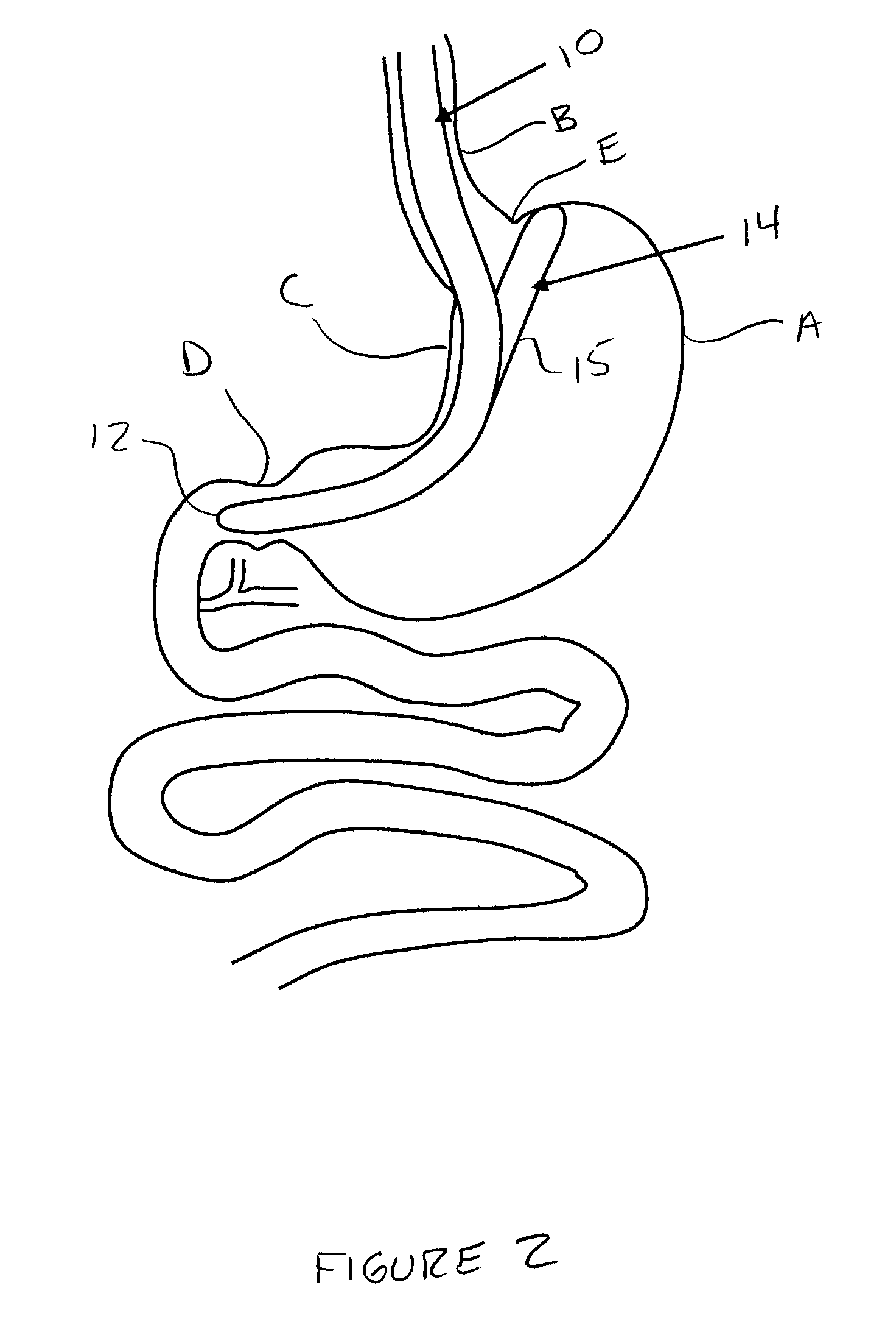 Methods And Devices For Performing Gastroplasty