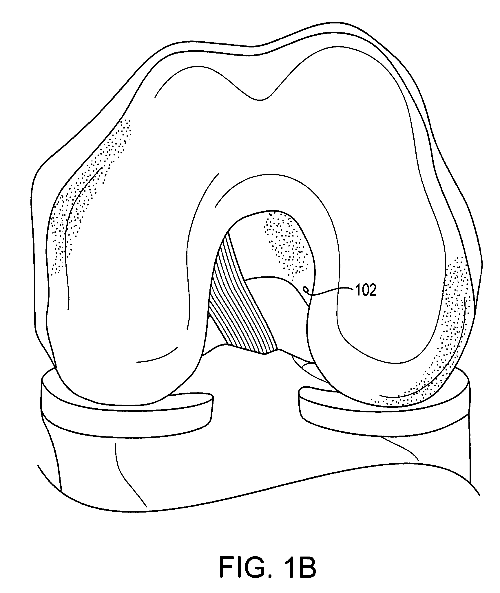 Method of ACL reconstruction using dual-sided rotary drill cutter