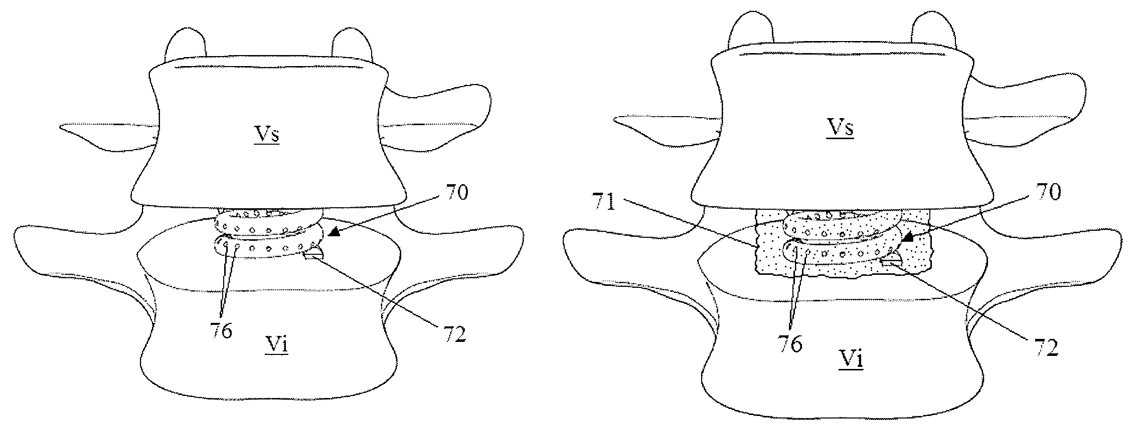 Insert for nucleus implant