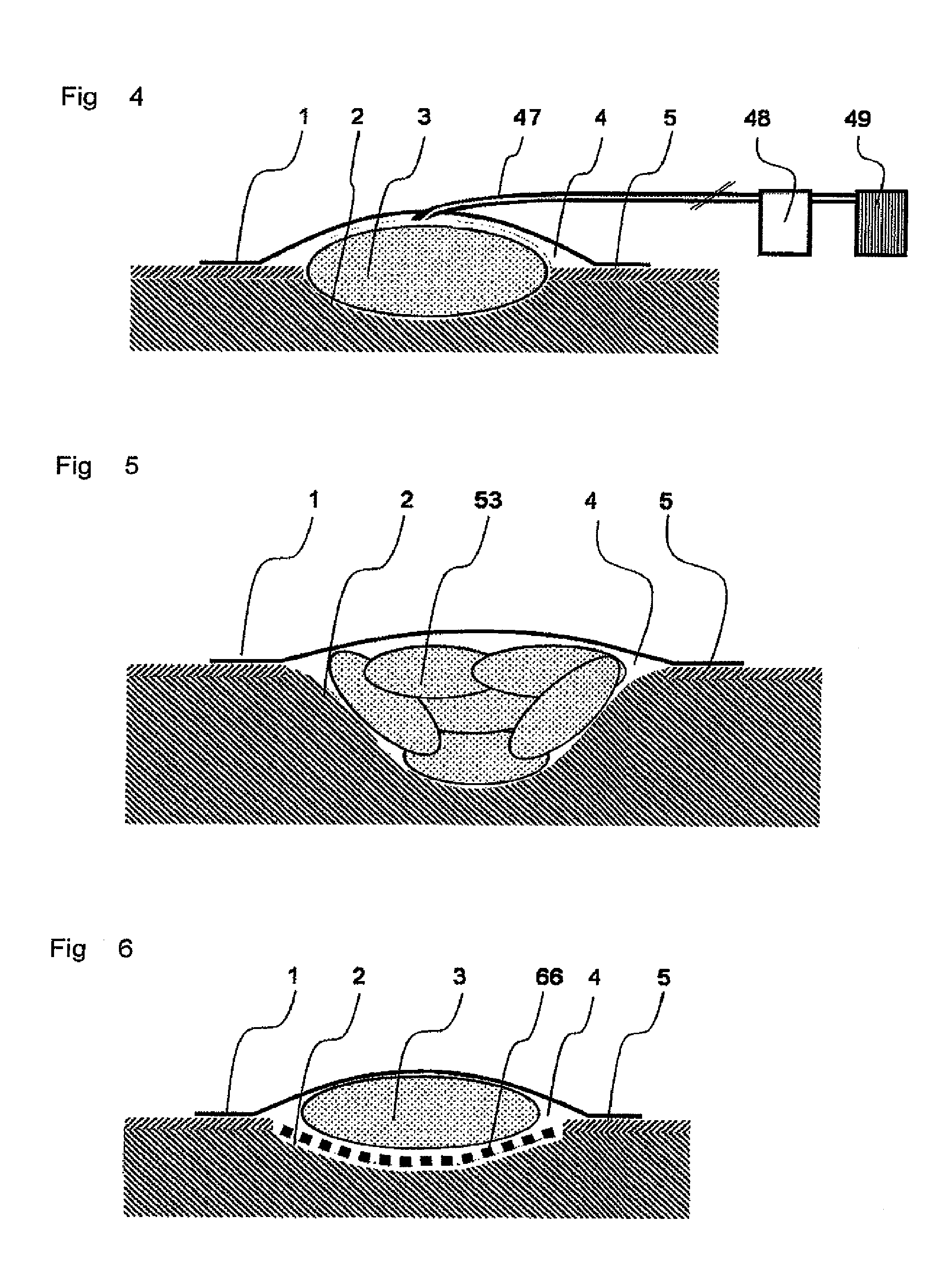 Method for vacuum therapy of wounds