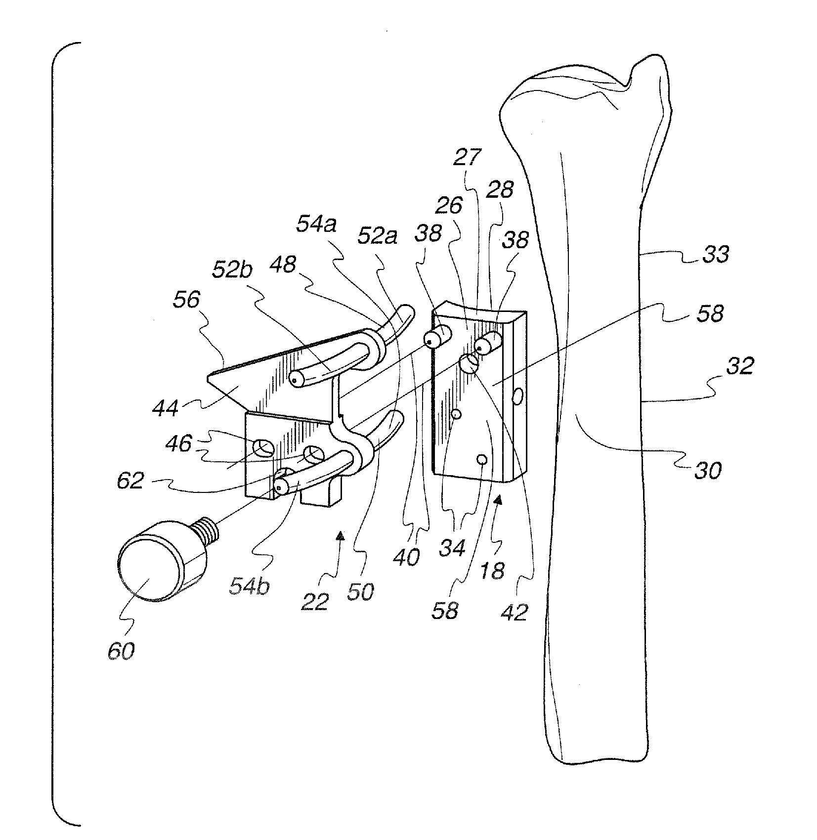 Method of performing osteotomy