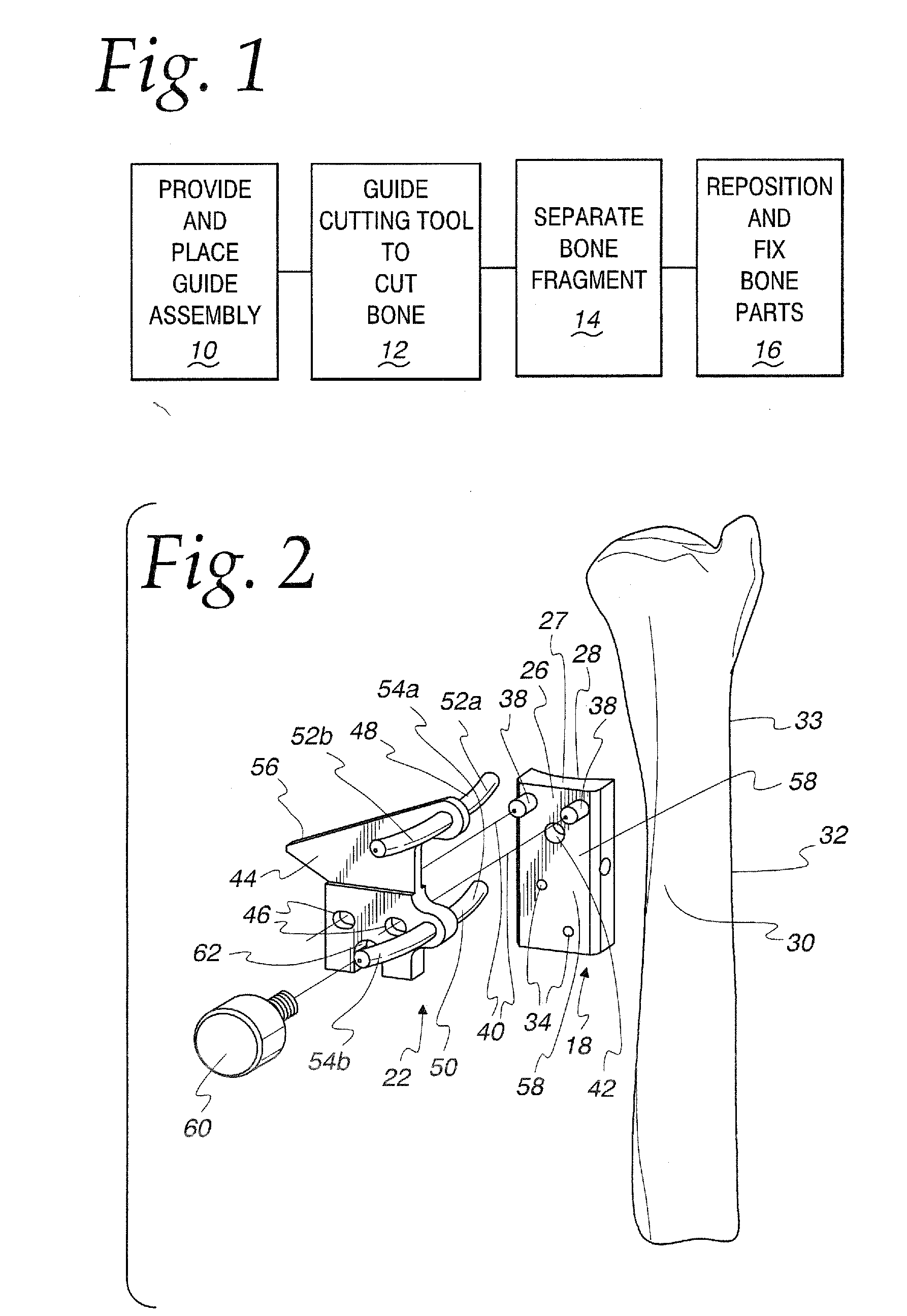 Method of performing osteotomy