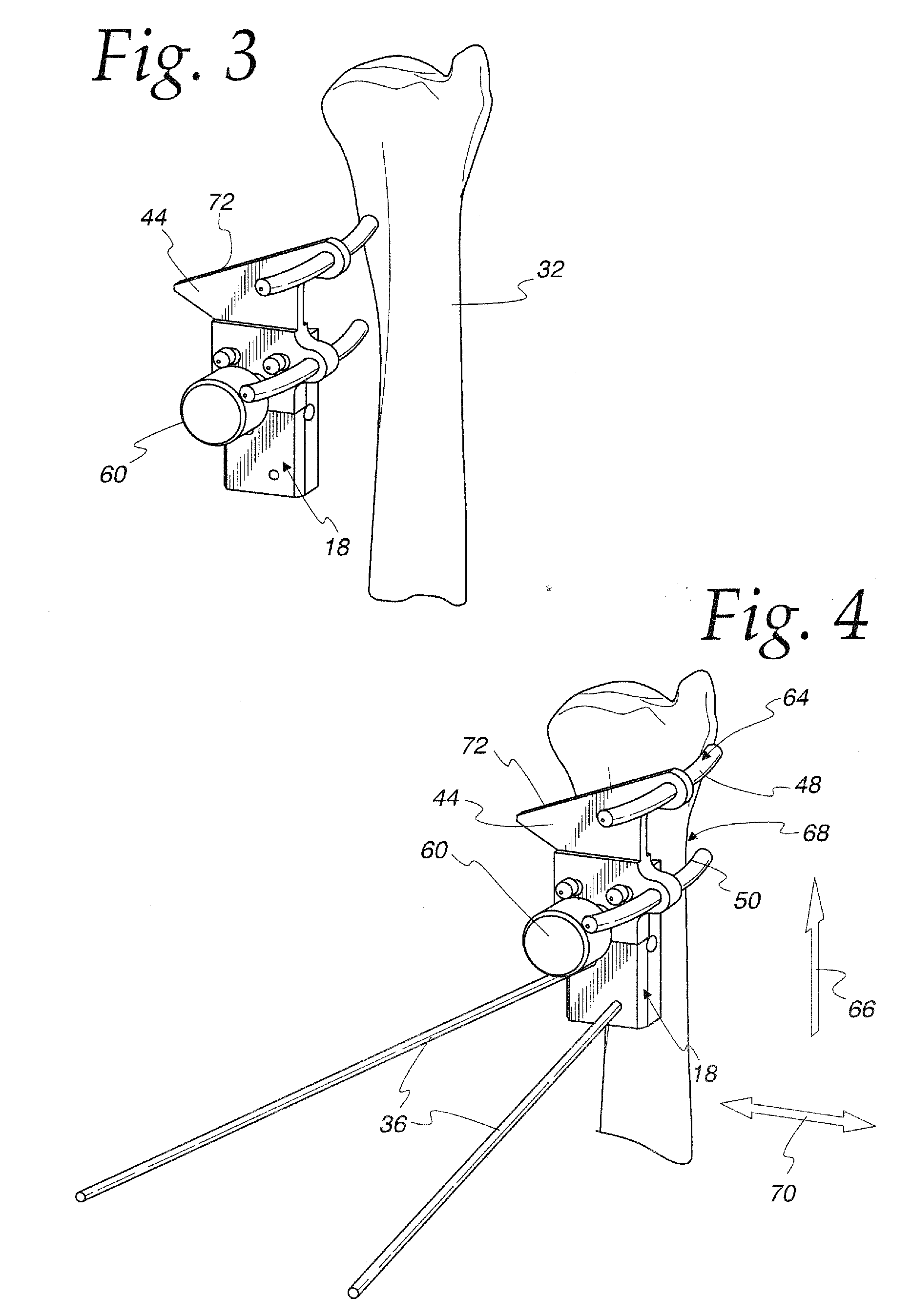 Method of performing osteotomy