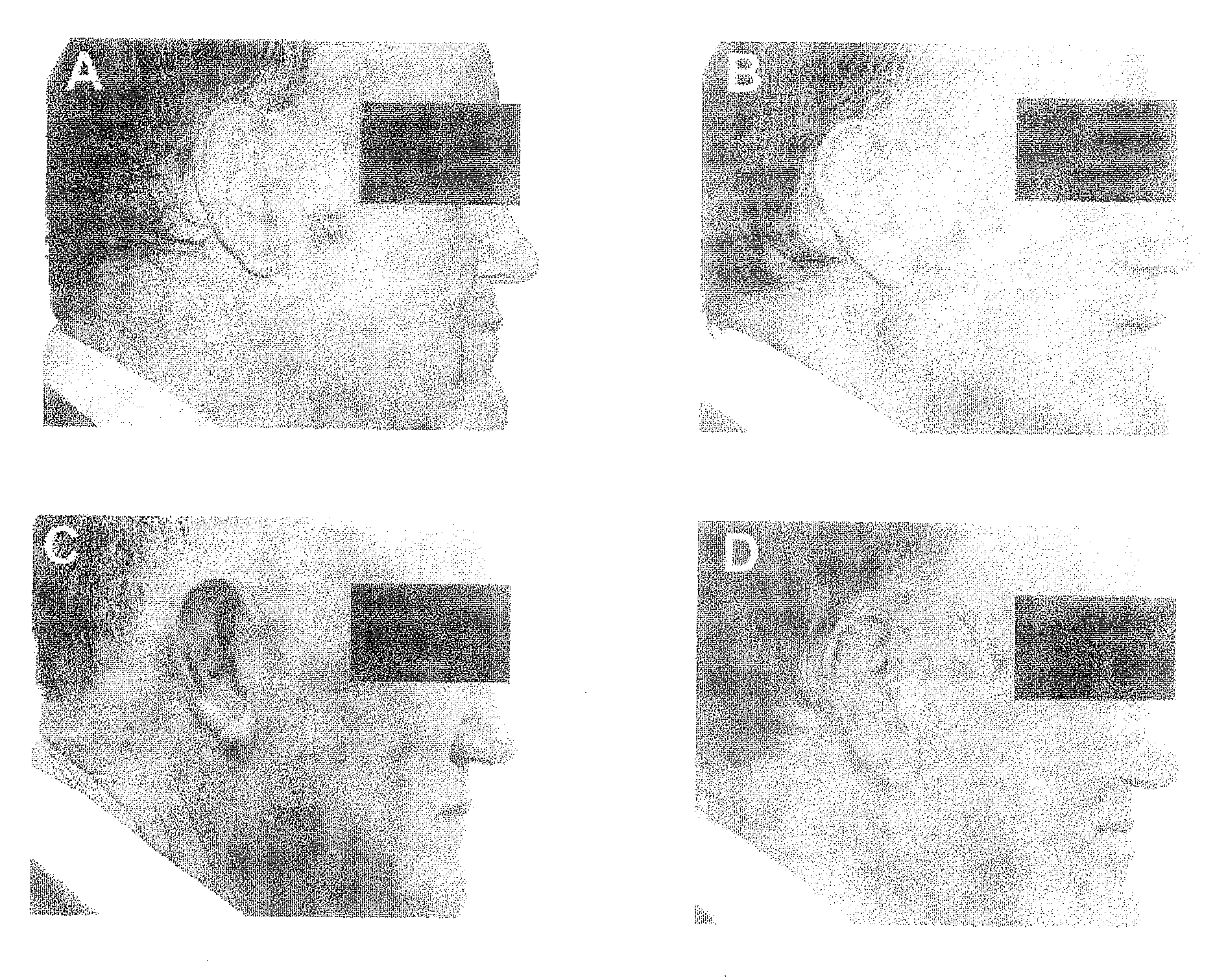 Methods of use for 2,5-dihydroxybenzene sulfonic acid compounds for the treatment of cancer, rosacea and psoriasis