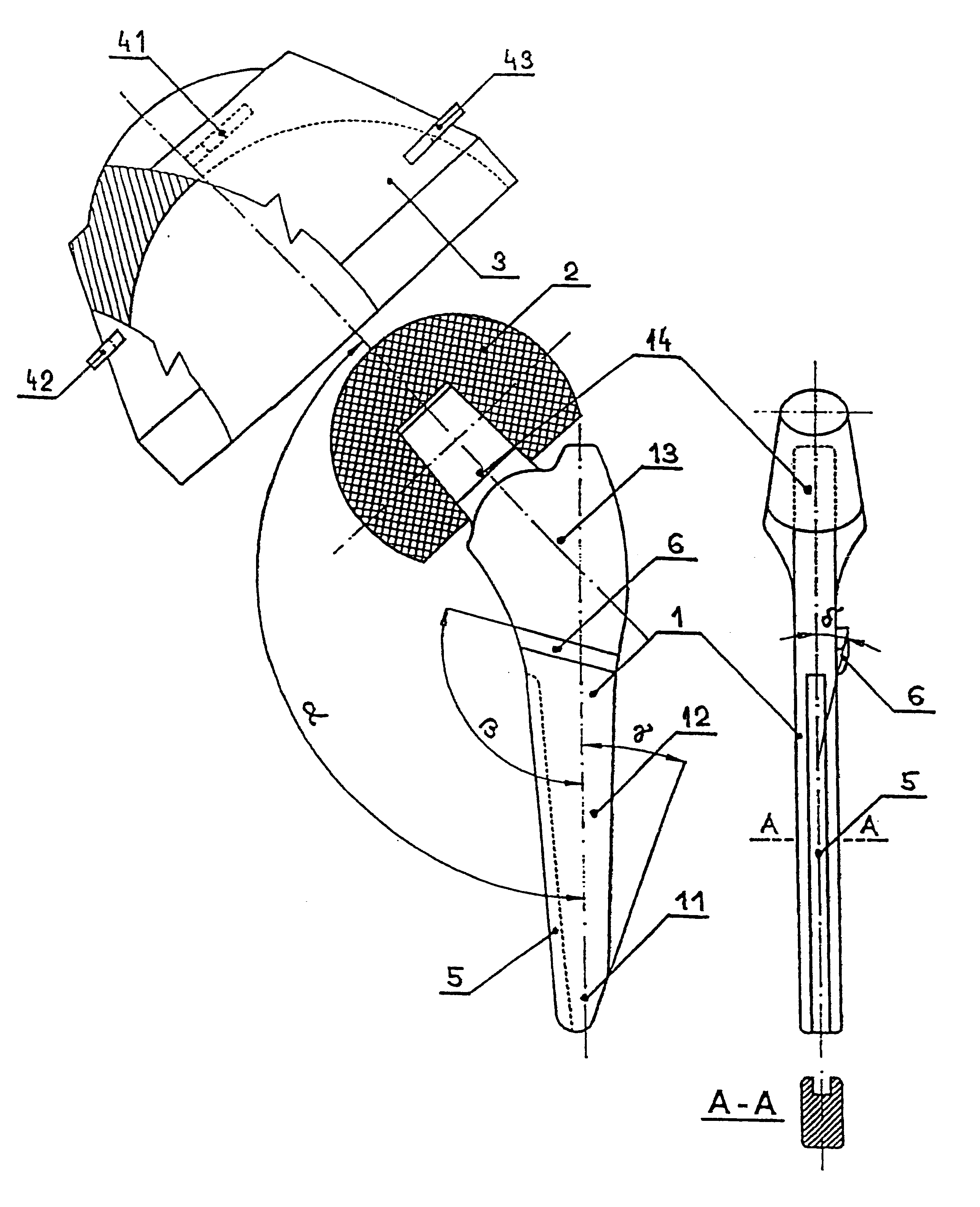 Cementless total replacement of the human hip joint