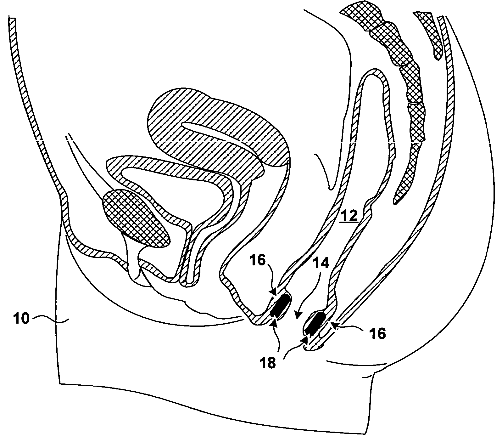 Implantable devices and methods for treating fecal incontinence