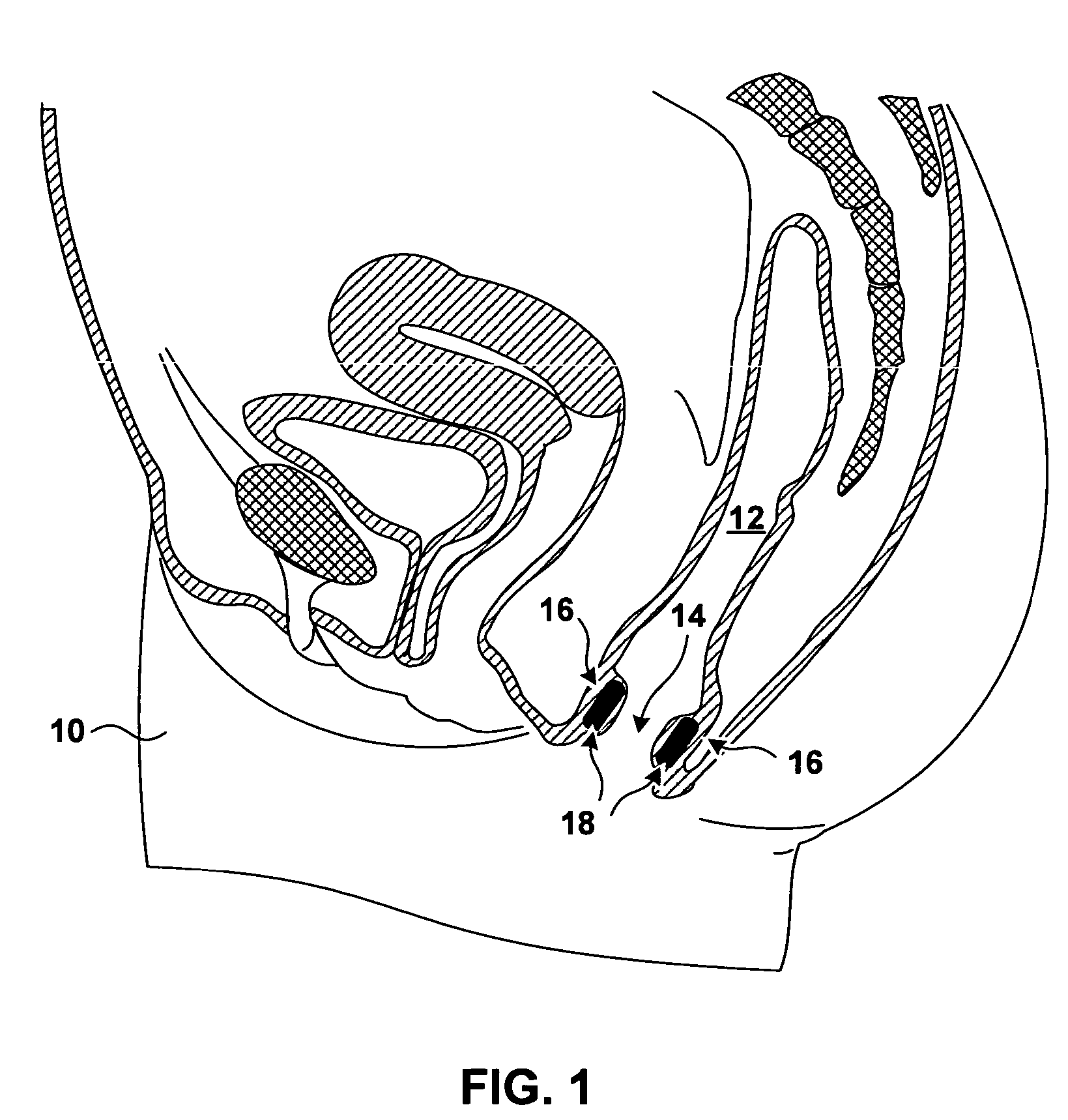 Implantable devices and methods for treating fecal incontinence