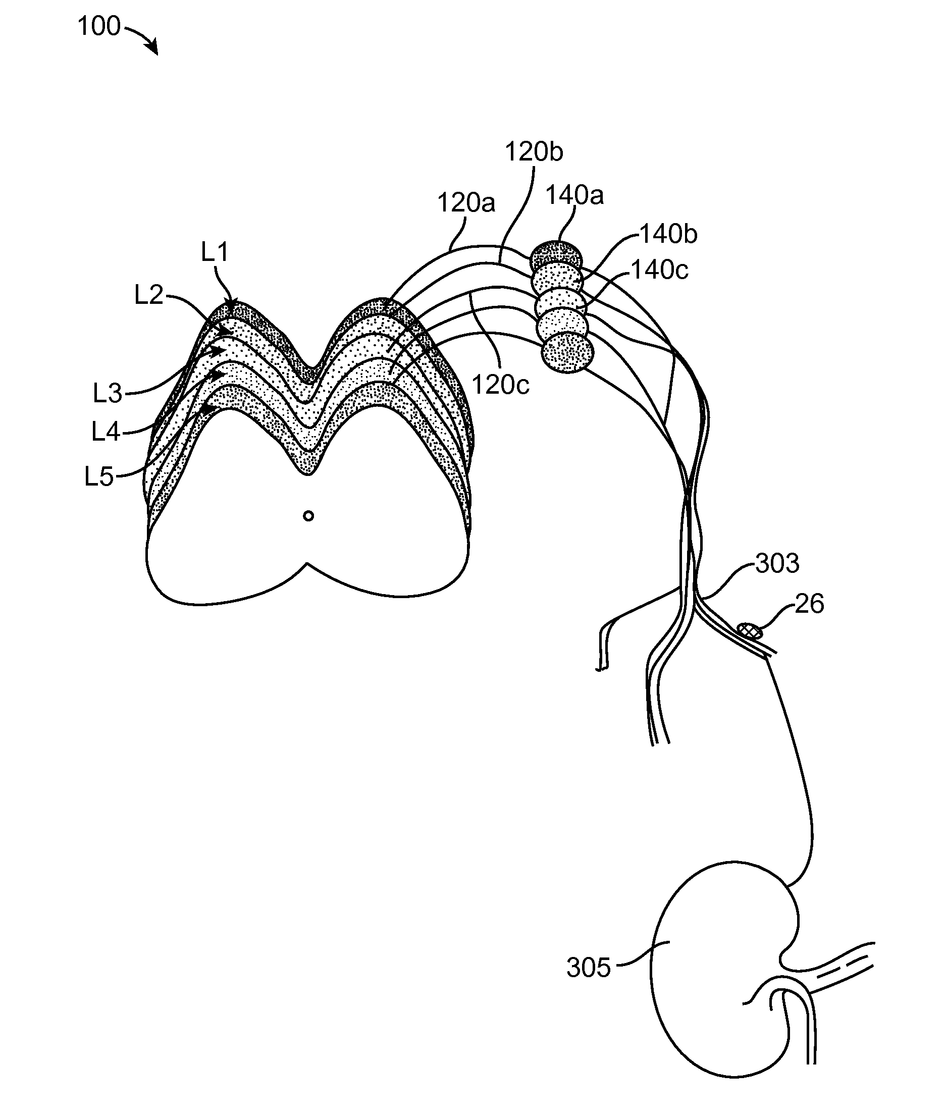 Method for treating hypertension via electrical stimulation of neural structures