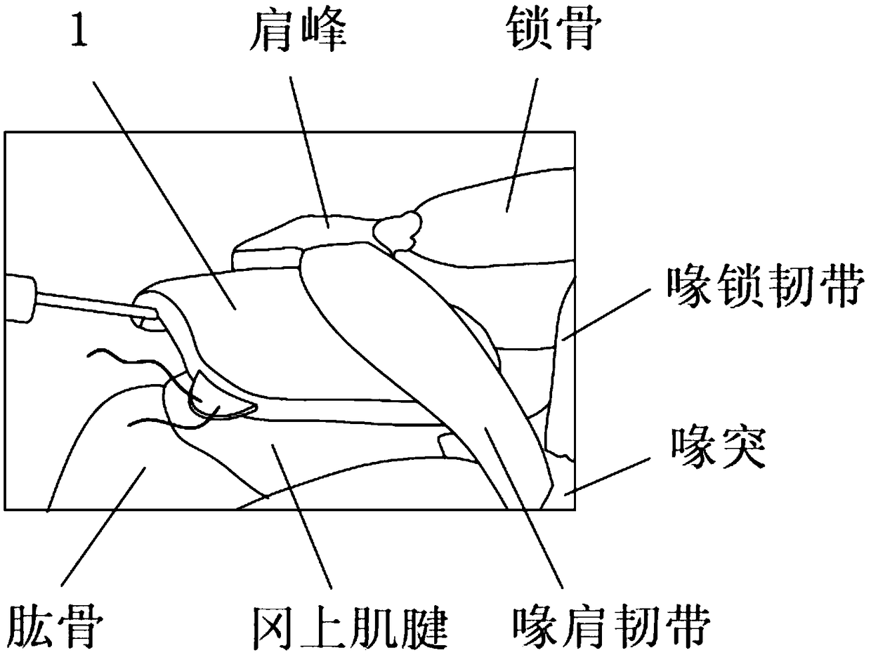 Fixable inflatable saccule