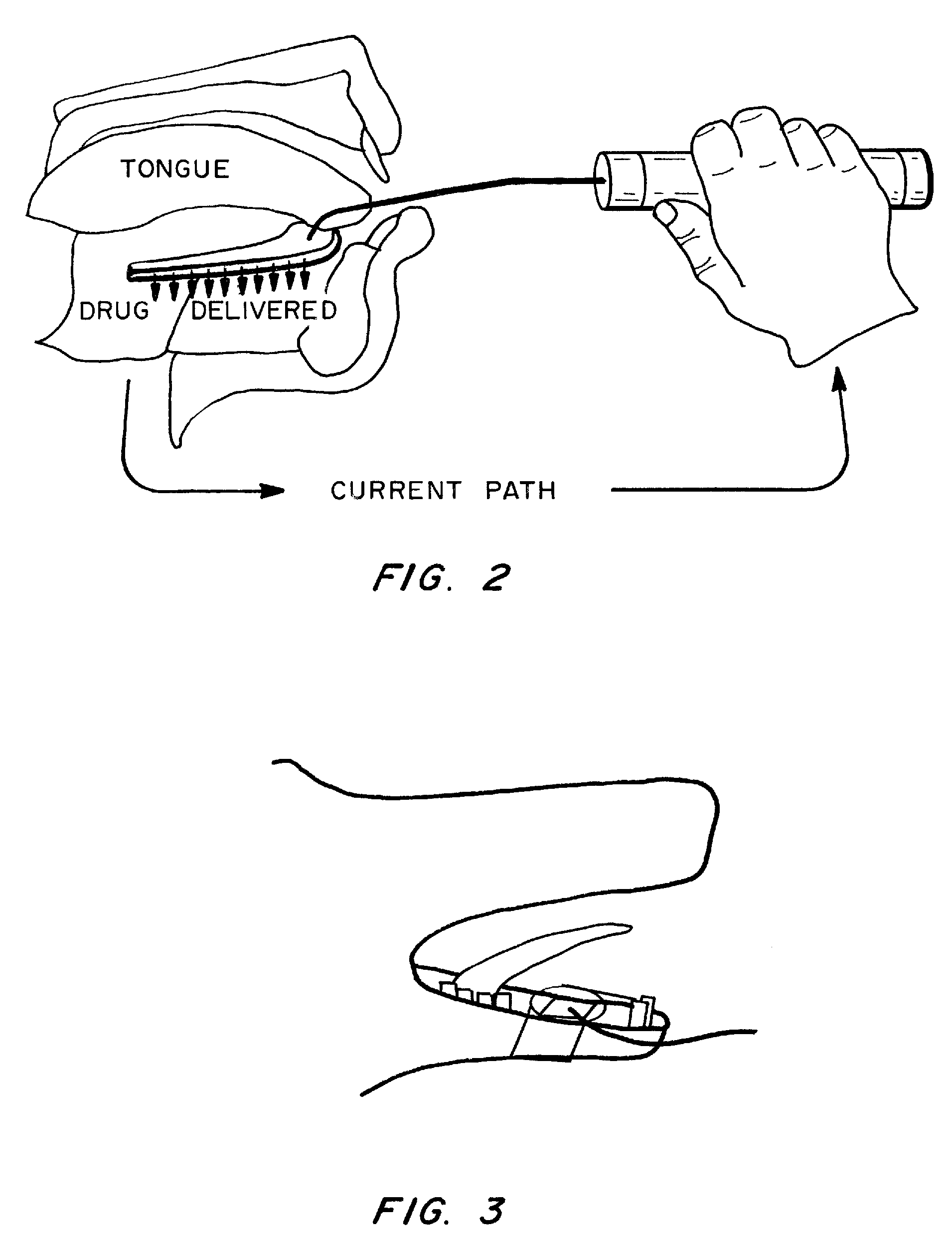 Method and Device for Sublingual Drug Delivery Using Iontophoresis