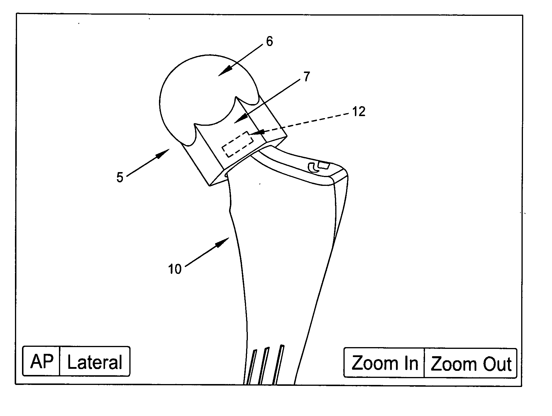 Computer-guided system for orienting the acetabular cup in the pelvis during total hip replacement surgery