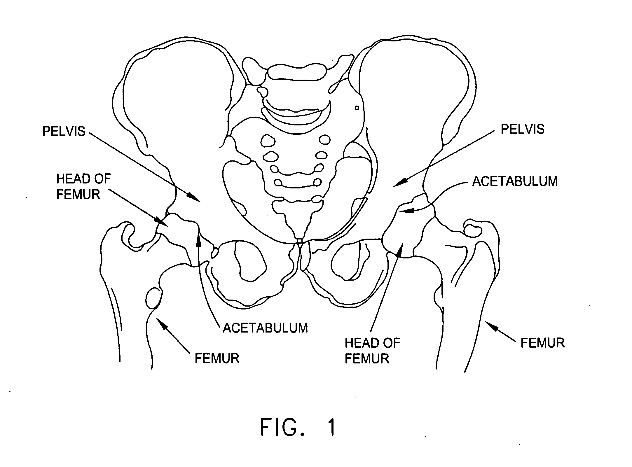 Computer-guided system for orienting the acetabular cup in the pelvis during total hip replacement surgery