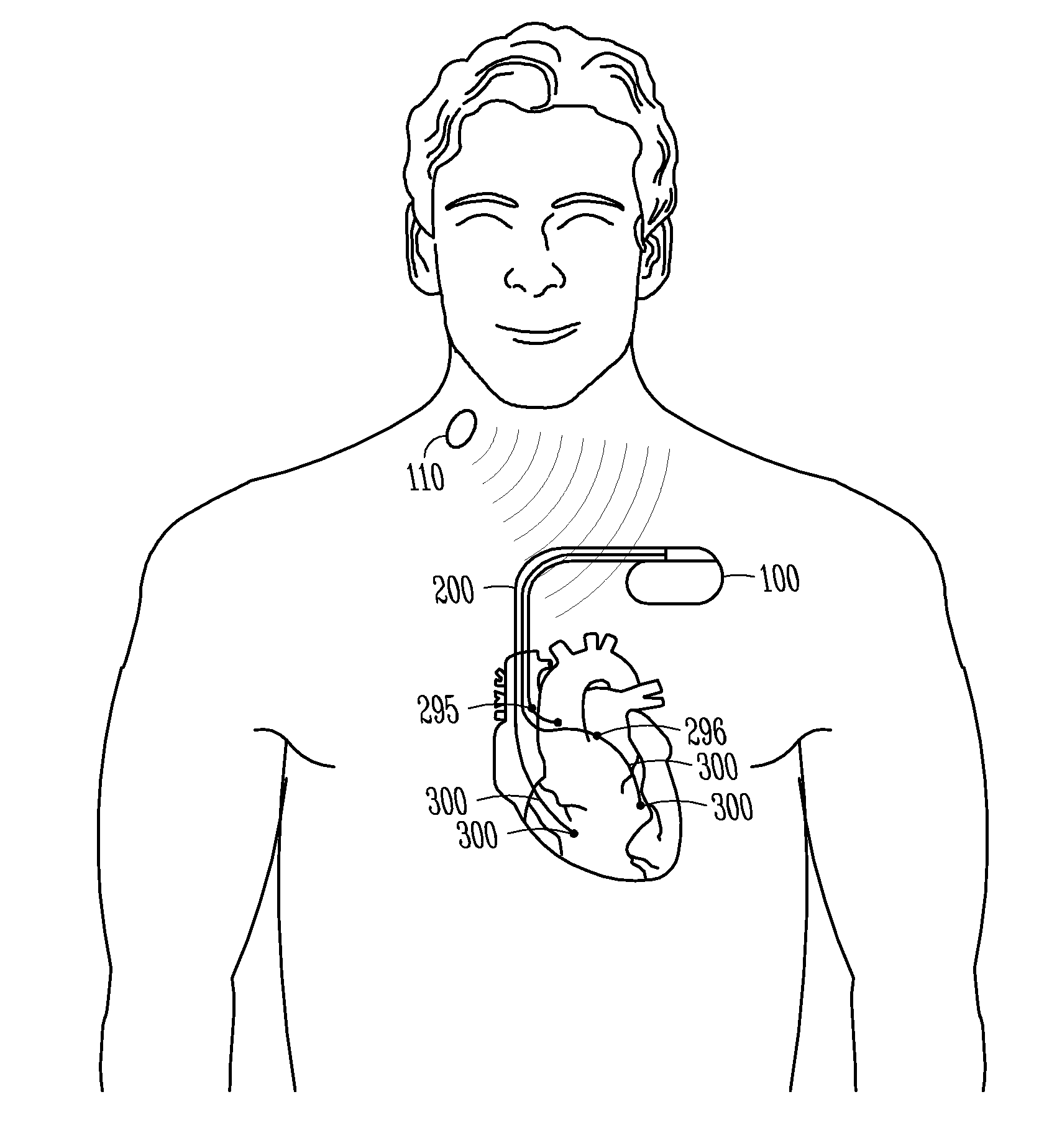 Transvascular neural stimulation device