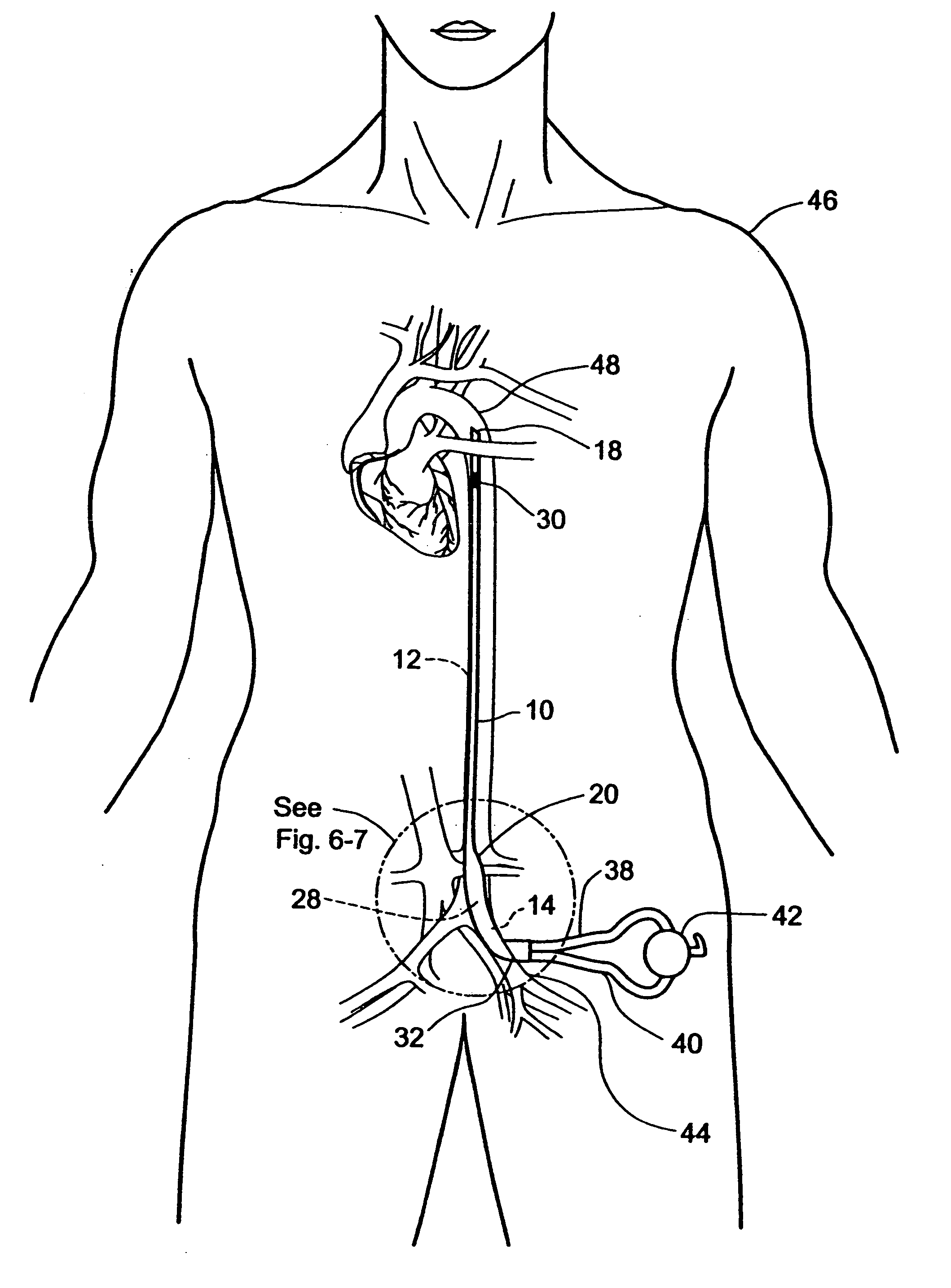 Multilumen catheter for minimizing limb ischemia