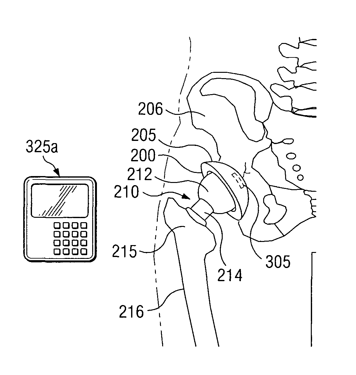 Methods for detecting osteolytic conditions in the body