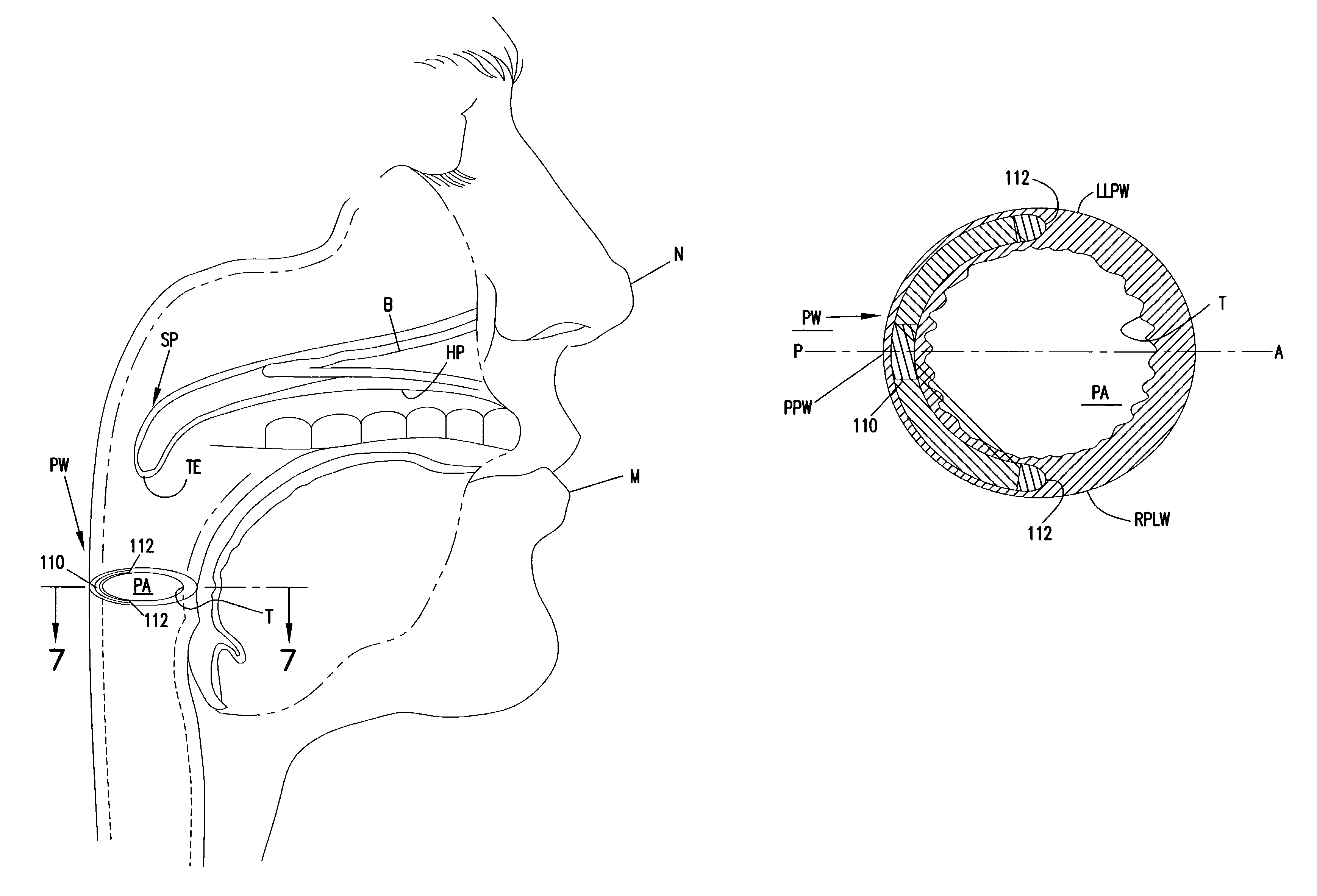 Stiffening pharyngeal wall treatment