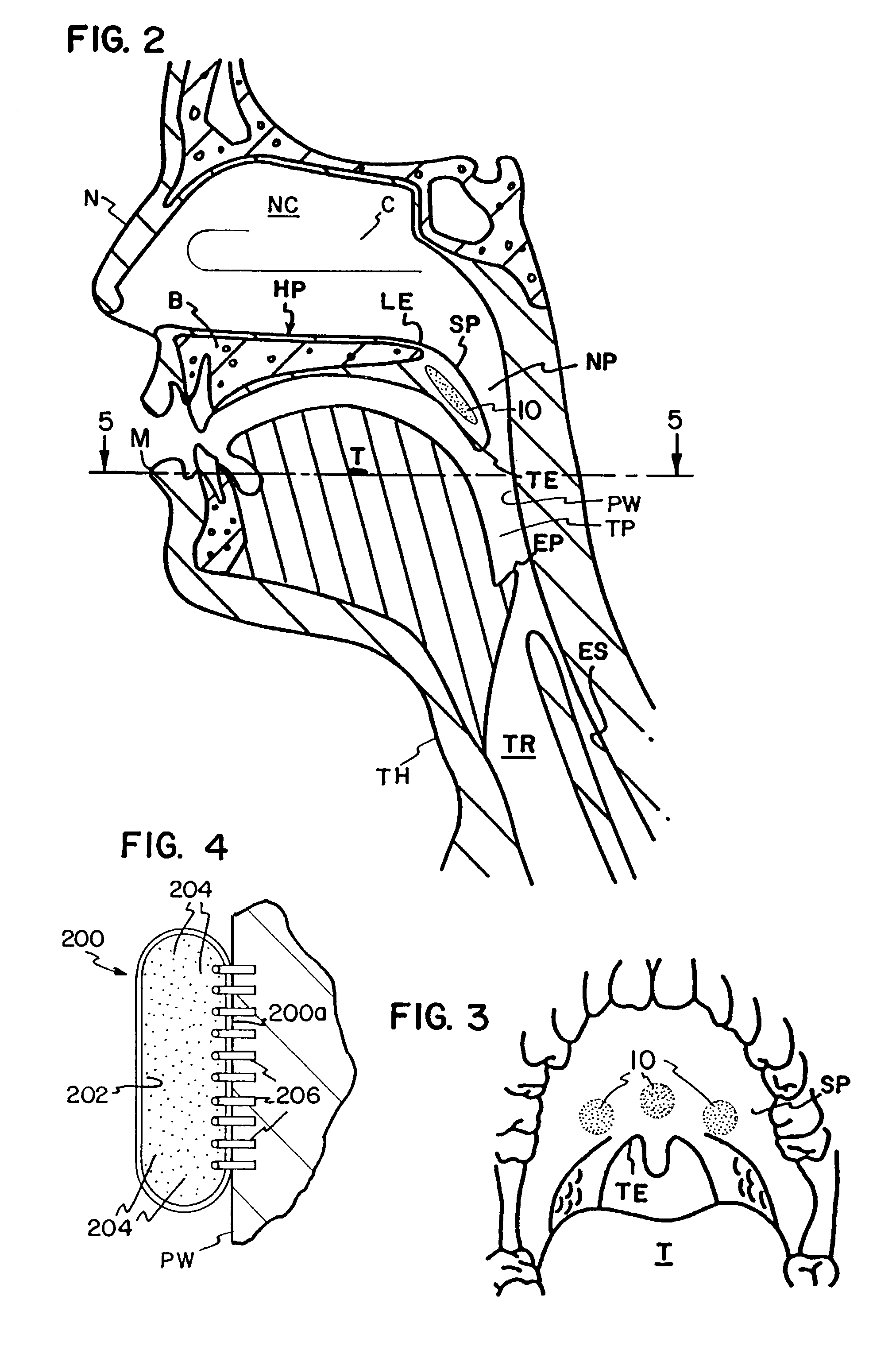 Stiffening pharyngeal wall treatment