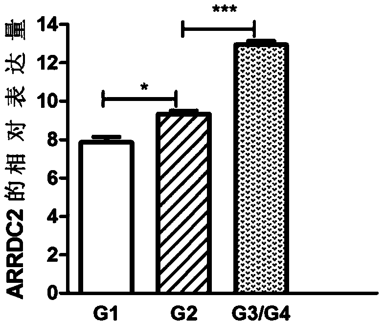 Application of ARRDC2 in evaluating development process of oral squamous cell carcinoma