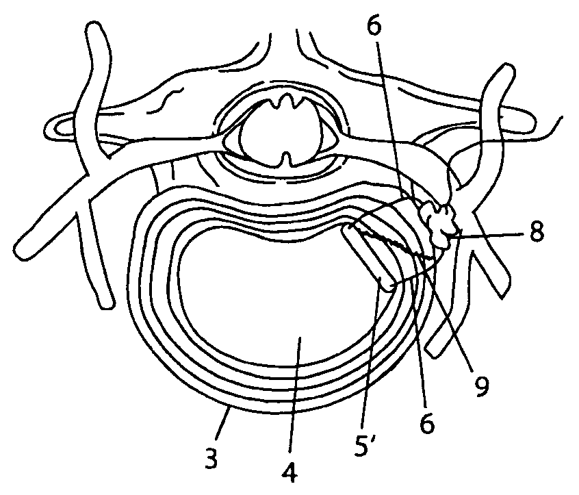 System and devices for the repair of a vertebral disc defect