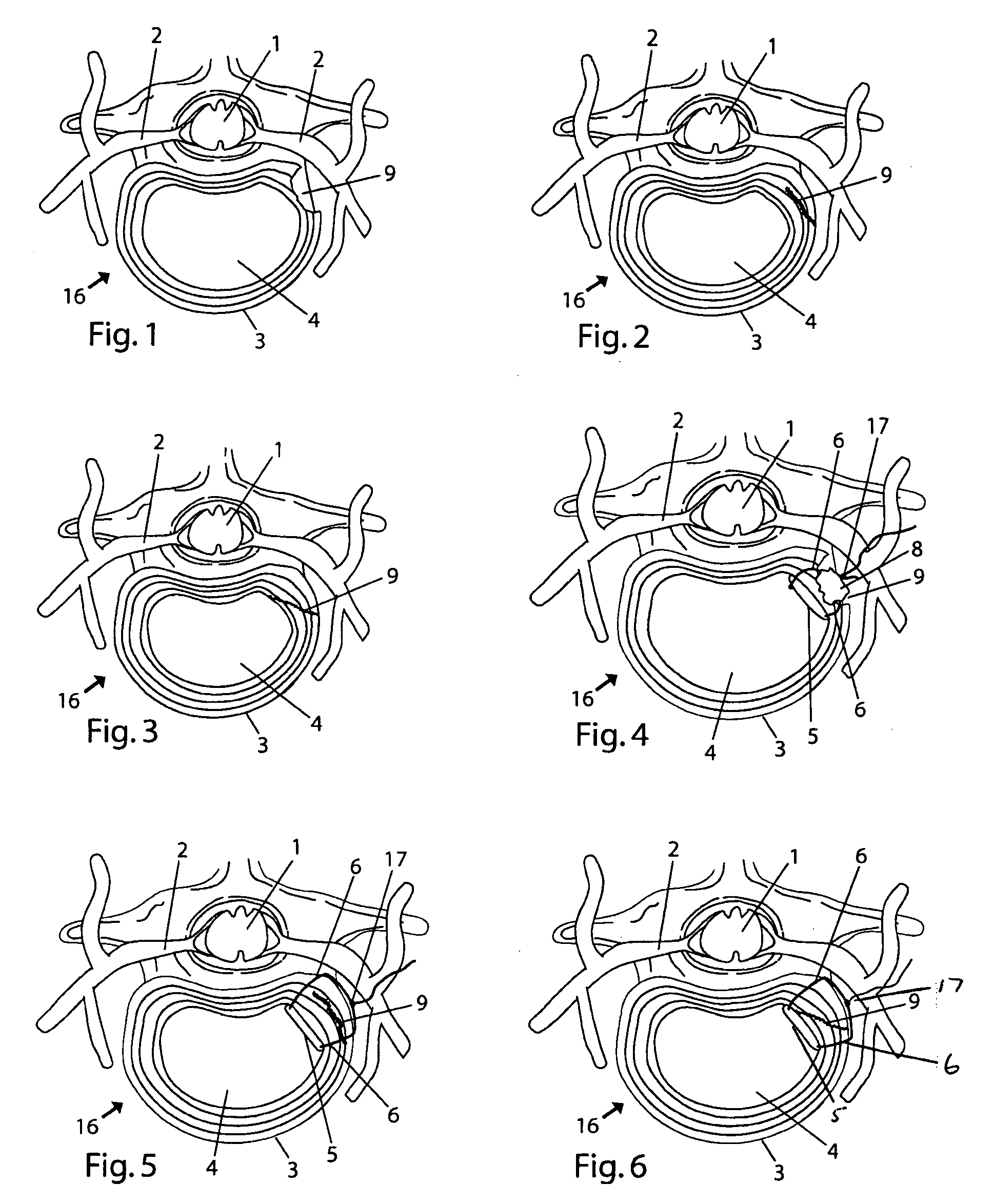 System and devices for the repair of a vertebral disc defect