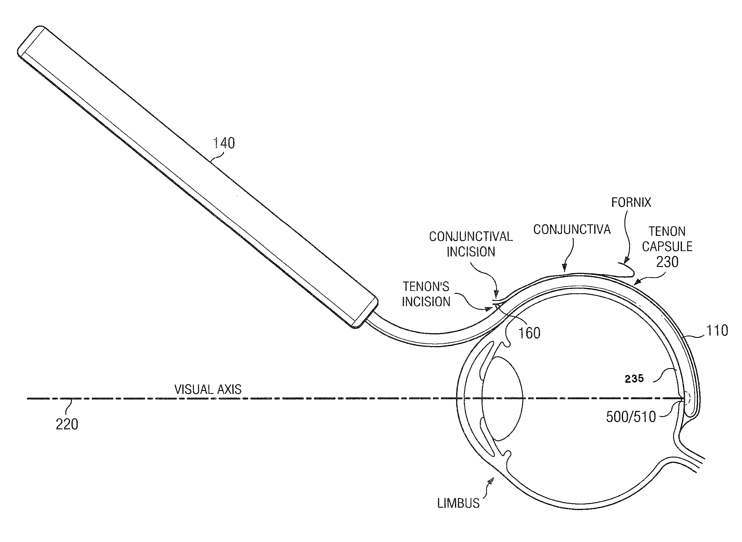 Methods and devices for minimally-invasive extraocular delivery of radiation to the posterior portion of the eye