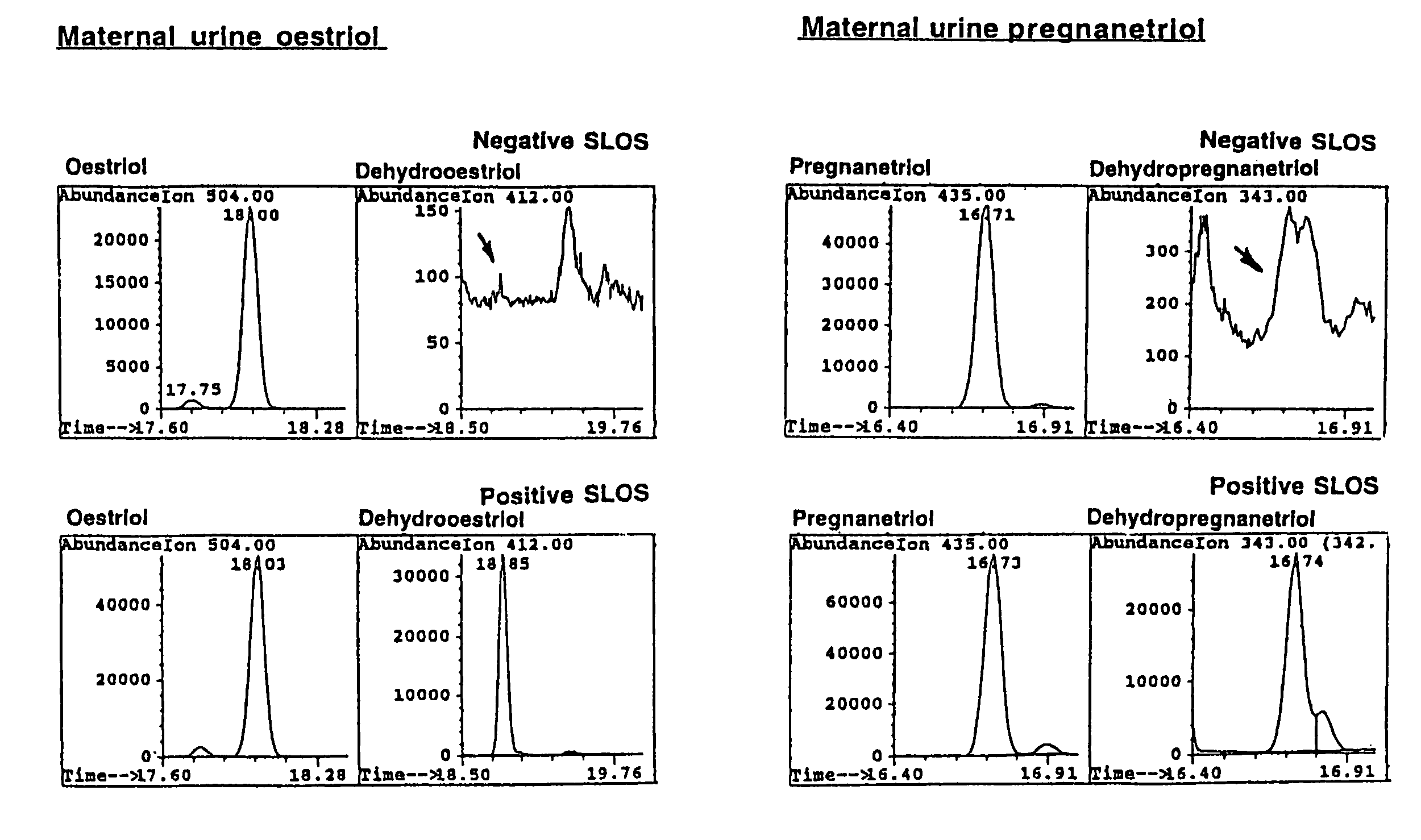 Diagnosis of Smith-Lemli-Optiz syndrome