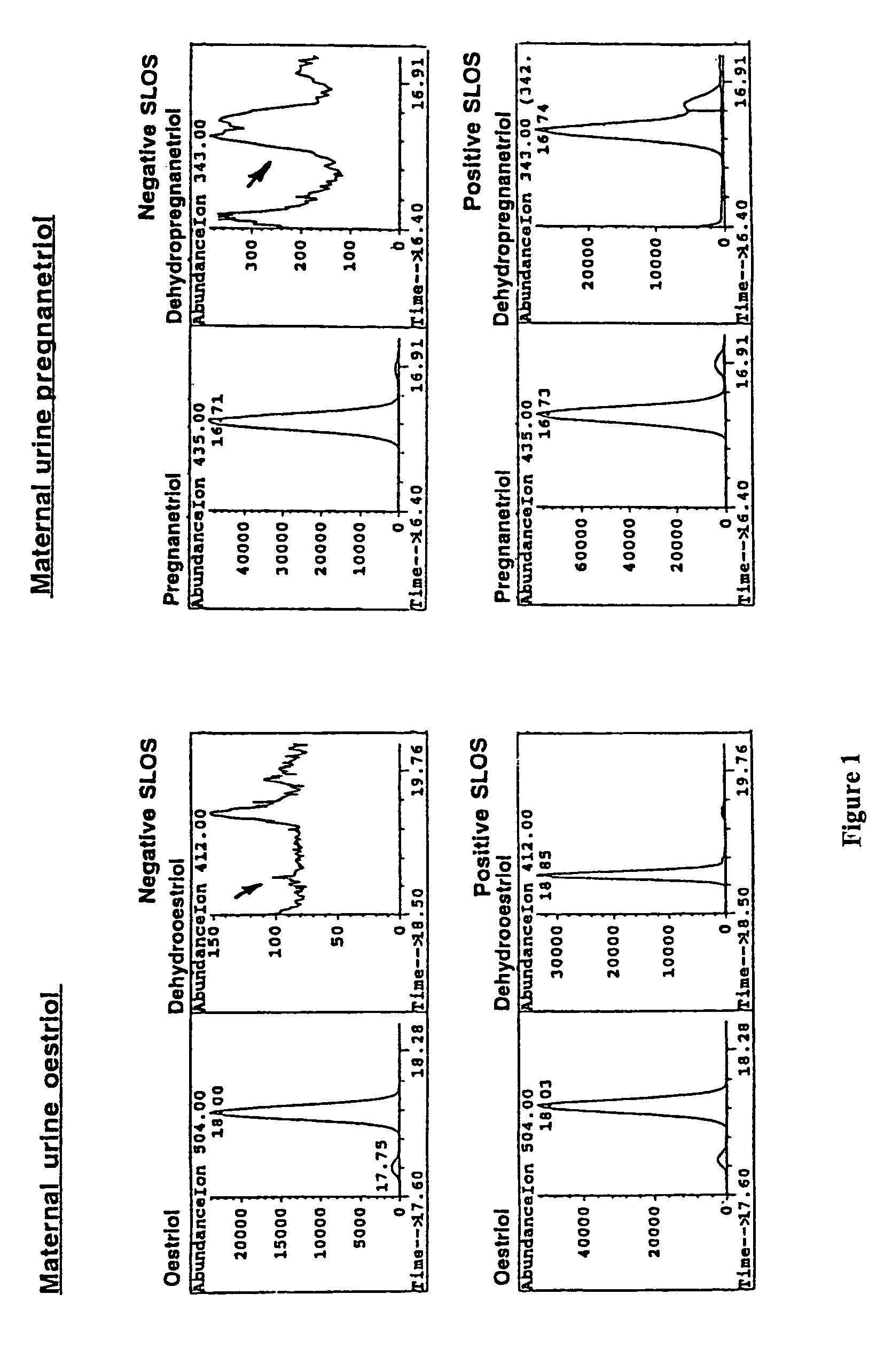 Diagnosis of Smith-Lemli-Optiz syndrome