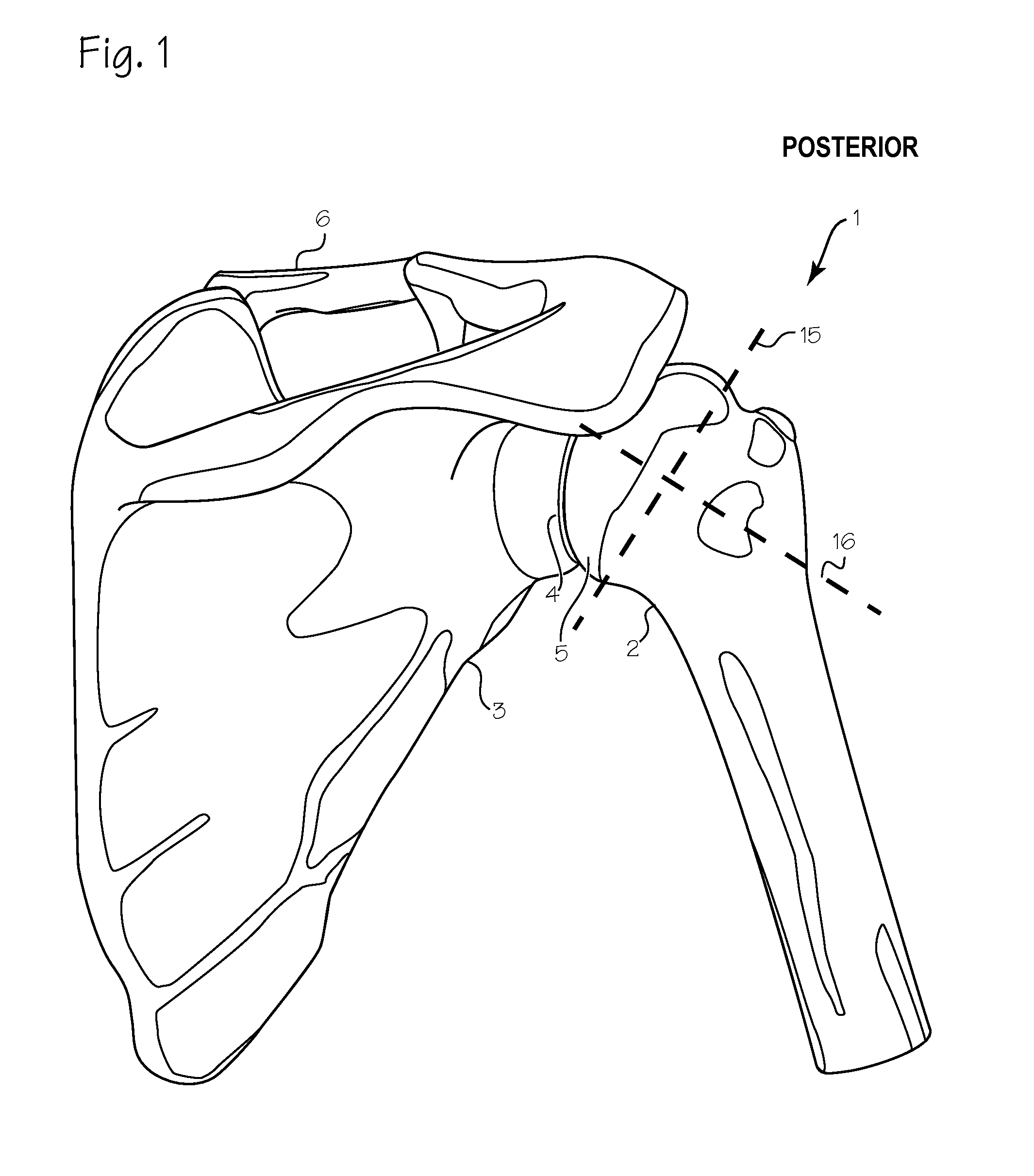 Method of humeral head resurfacing and/or replacement and system for accomplishing the method