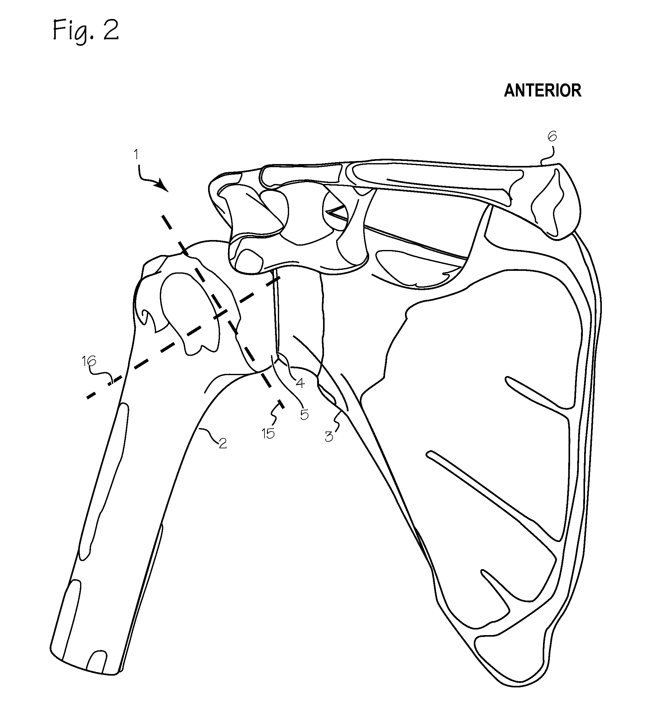 Method of humeral head resurfacing and/or replacement and system for accomplishing the method