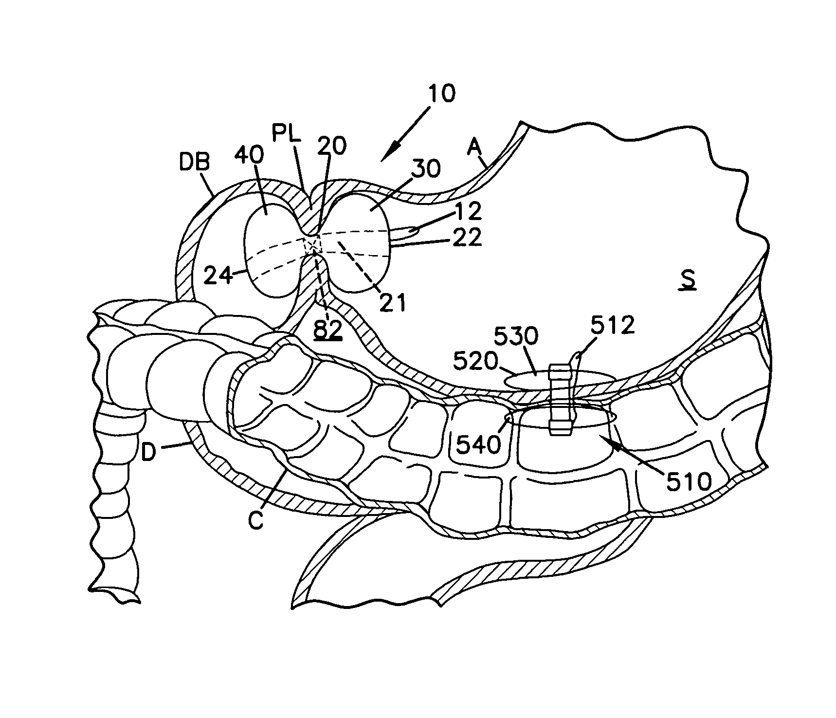 Obesity treatment and device