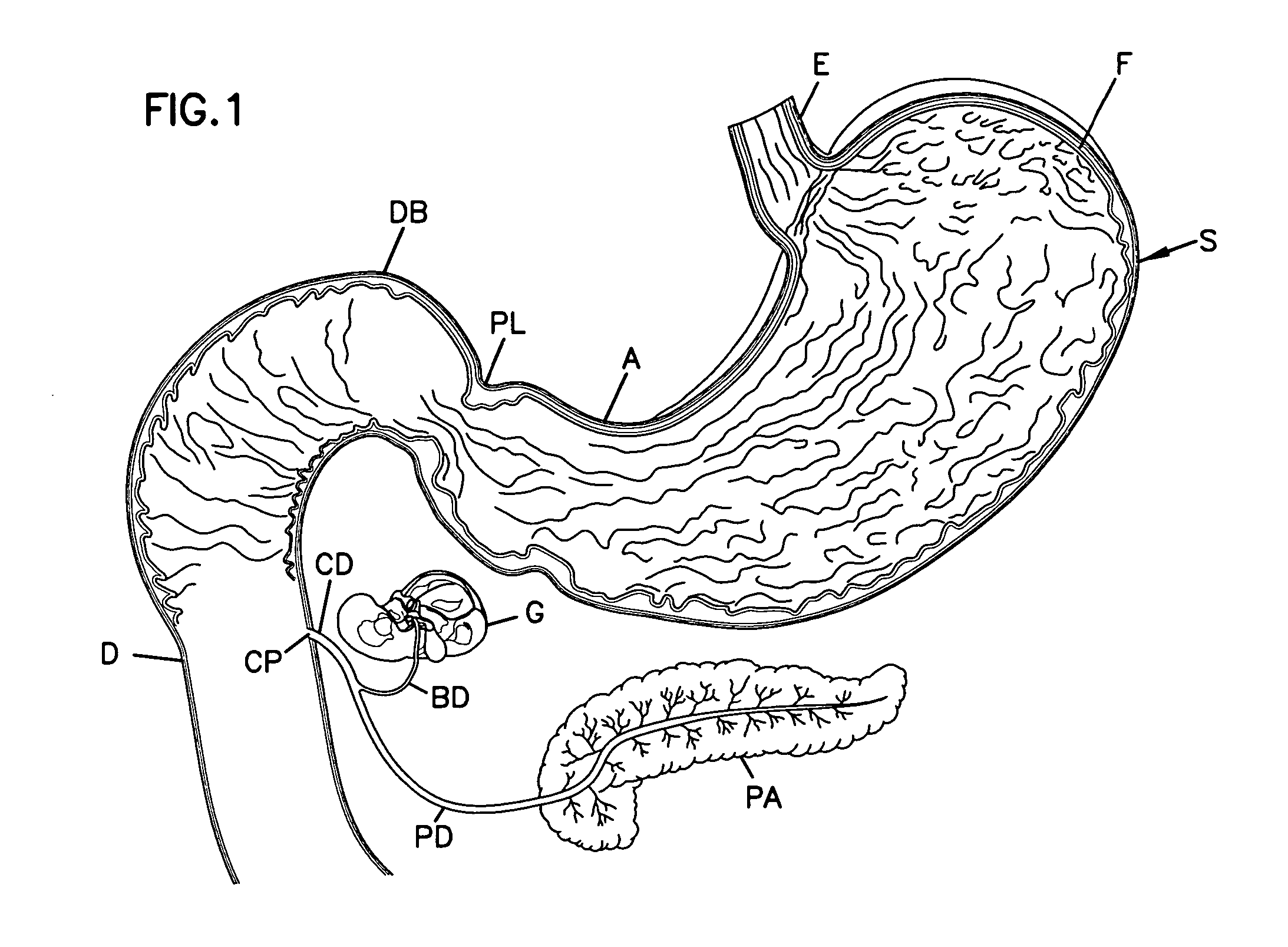 Obesity treatment and device