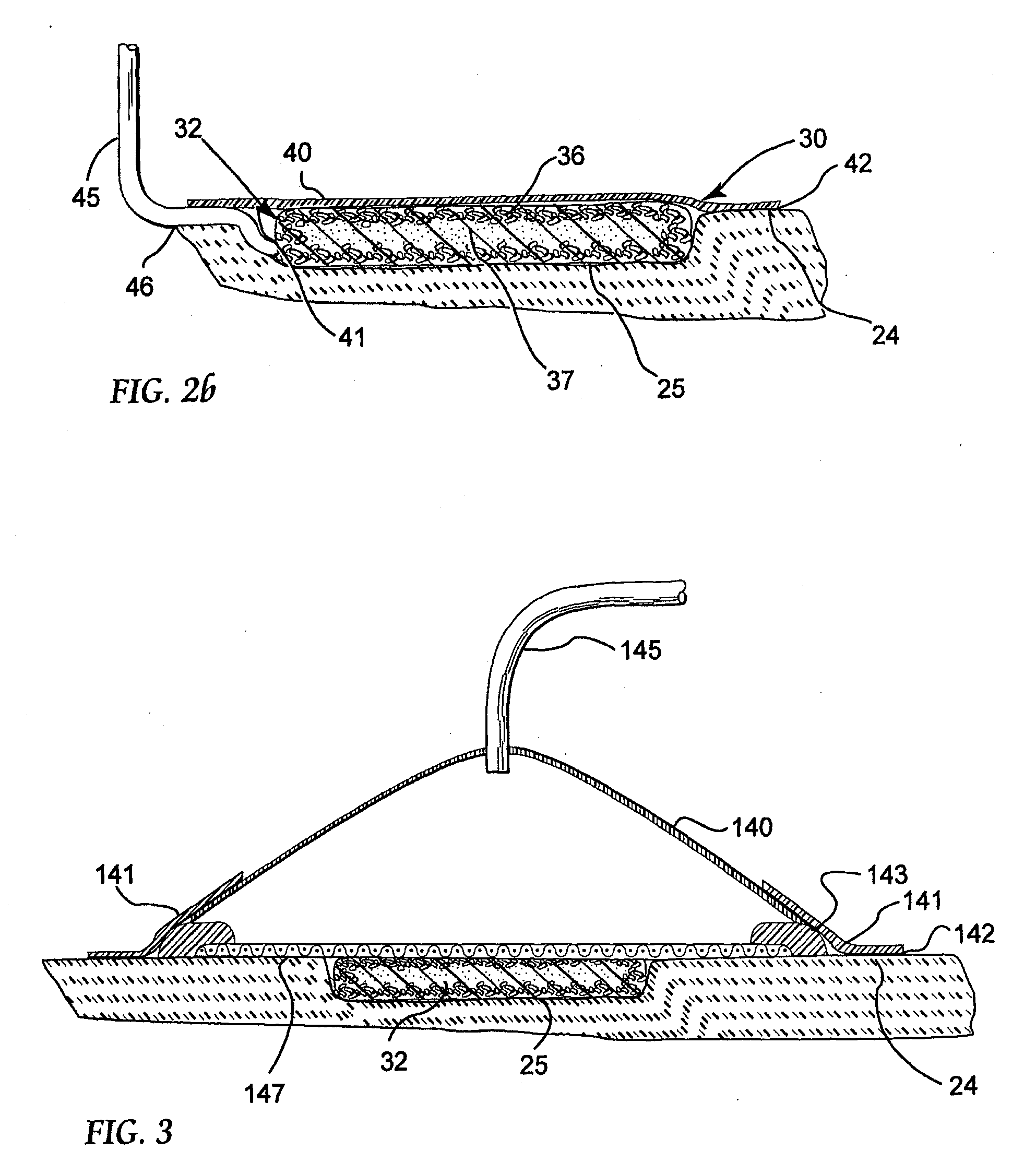 Reduced pressure treatment system