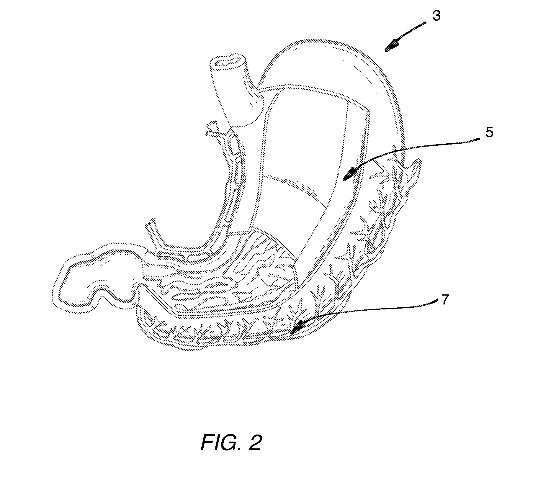 Noninvasive Method and Apparatus for Facilitating Weight Loss