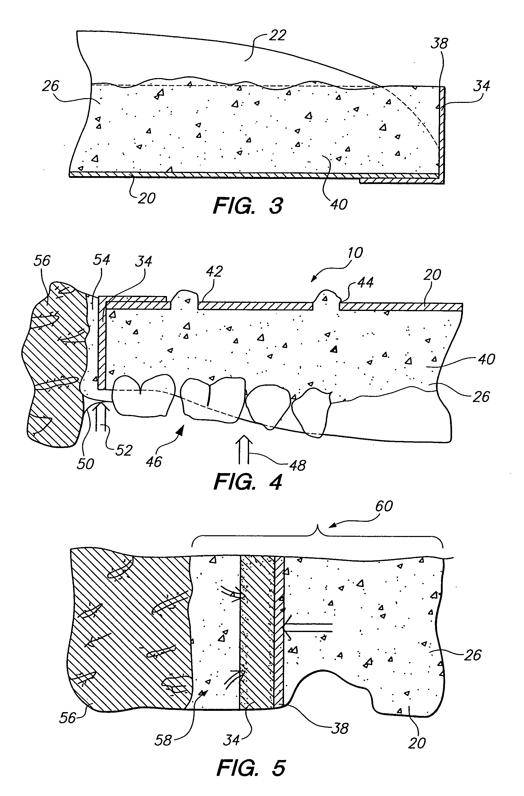 Dental impression dam system