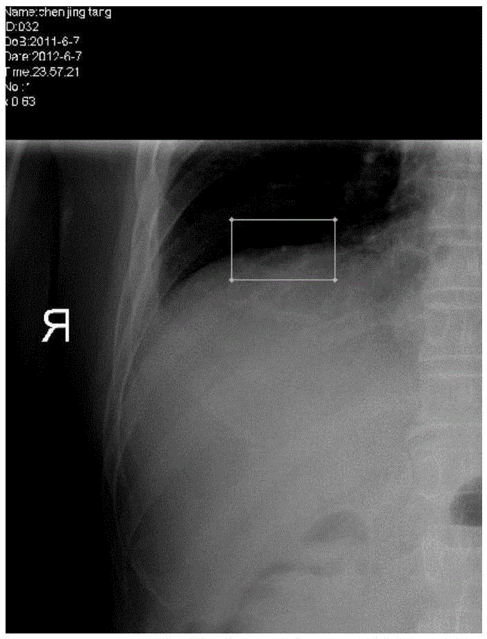 X-ray digestive tract image resolution evaluation method based on human anatomic structure