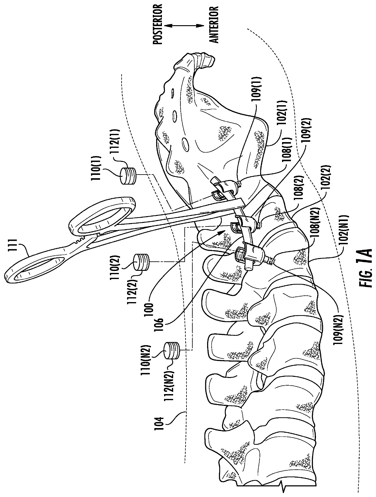 Multi-mode torque drivers employing Anti-backdrive units for managing pedicle screw attachments with vertebrae, and related systems and methods