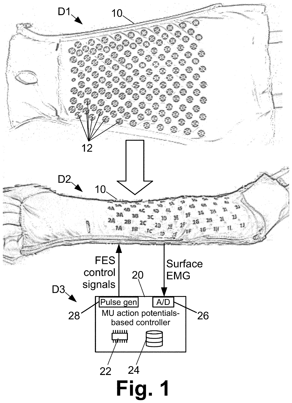 Control of functional electrical stimulation using motor unit action potentials