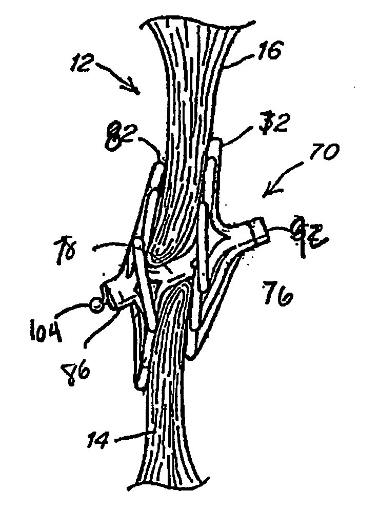 Adjustable length patent foramen ovale (PFO) occluder and catch system