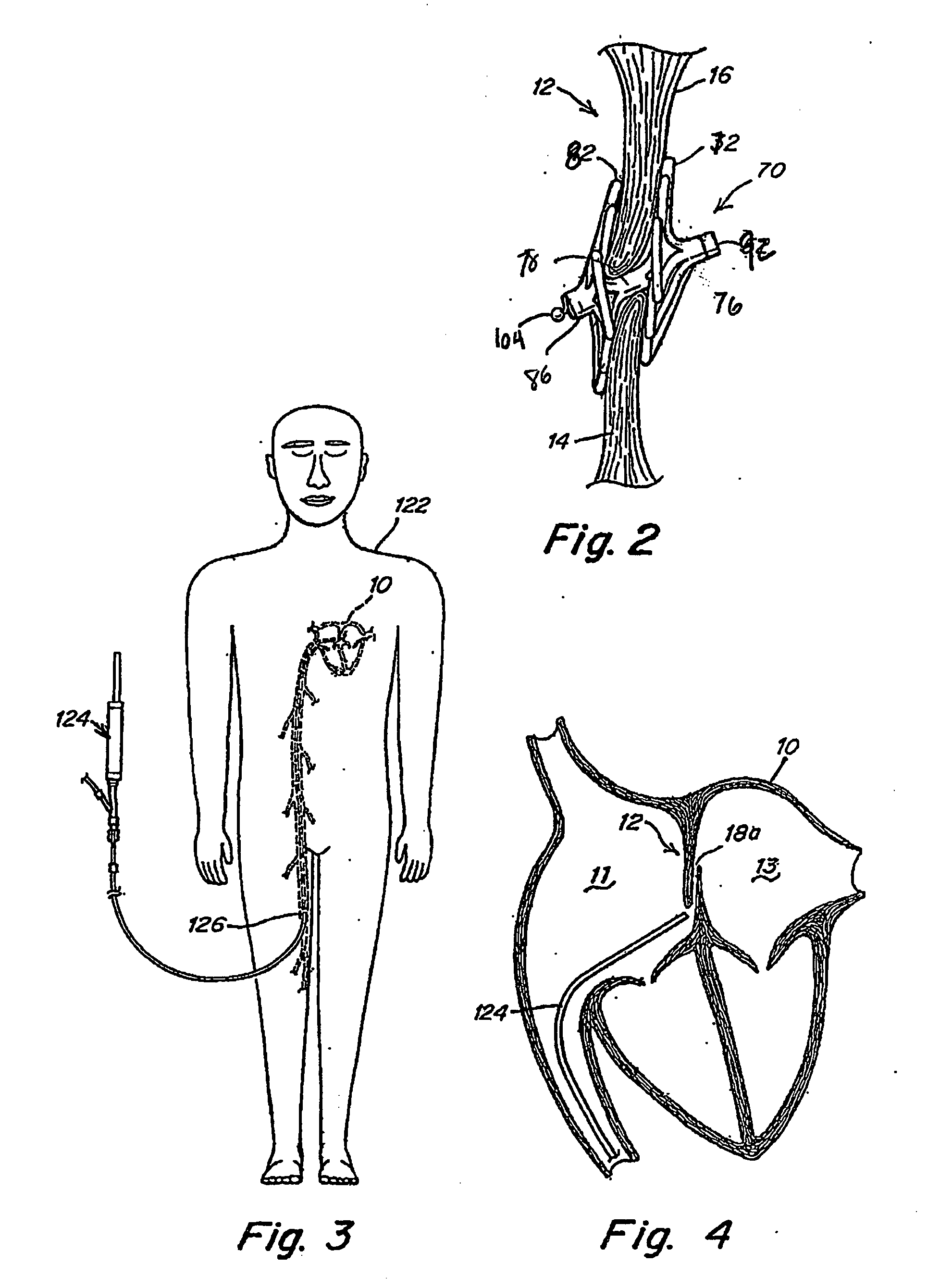 Adjustable length patent foramen ovale (PFO) occluder and catch system