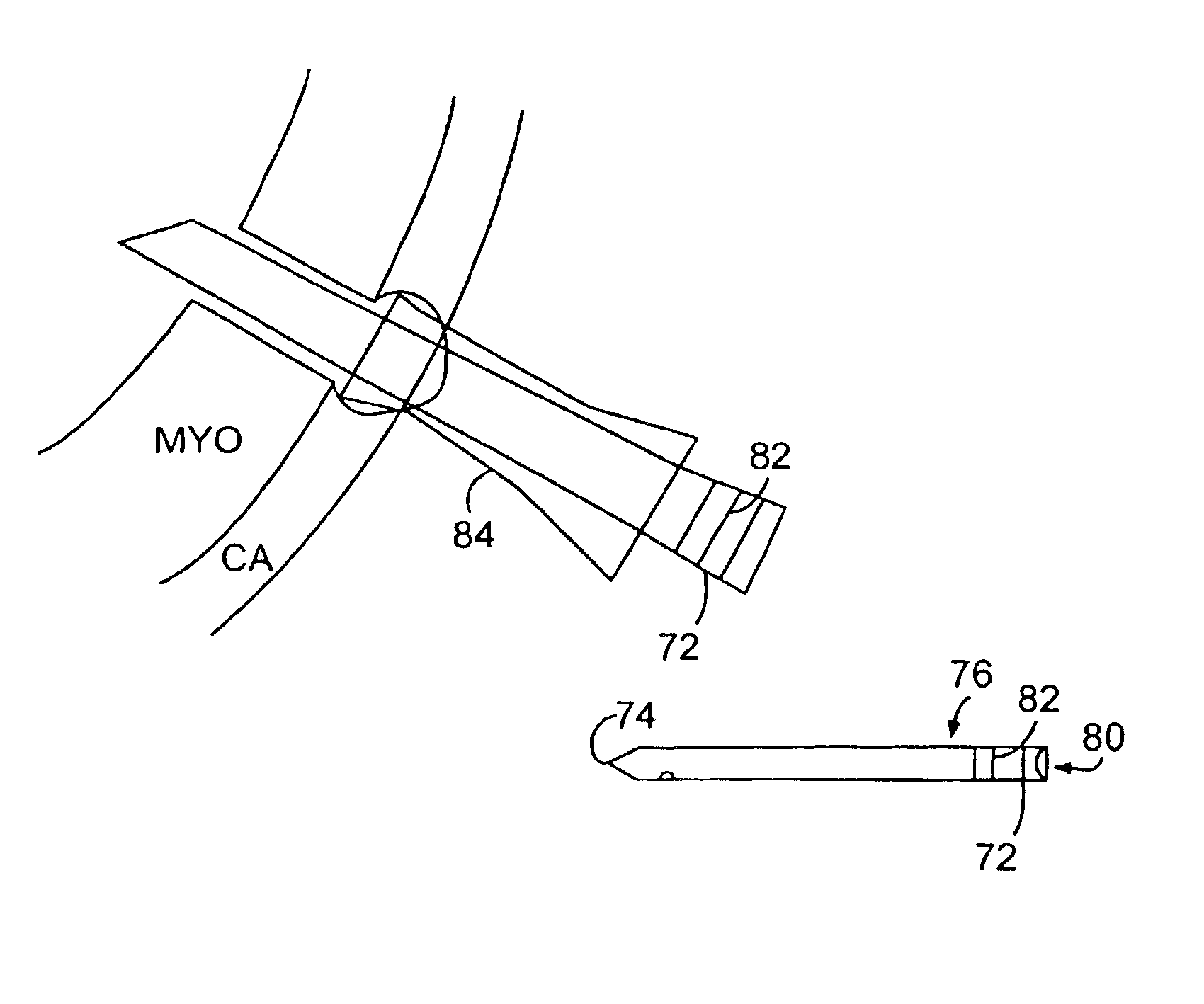 Left ventricular conduits and methods for delivery