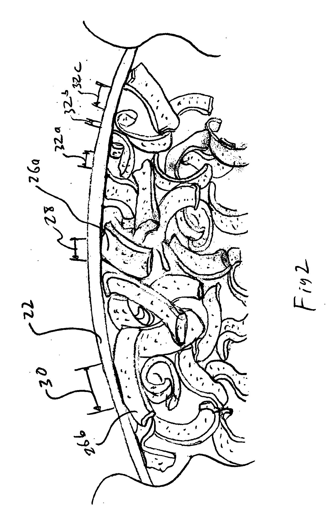 Reticulated open cell filling material