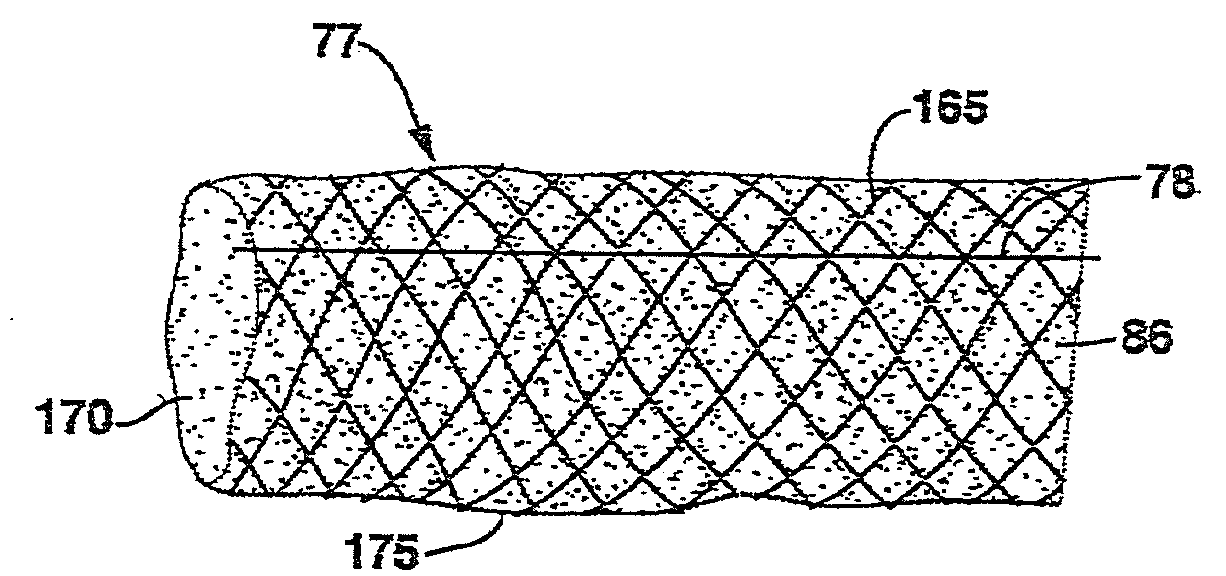 Compliant Venous Graft